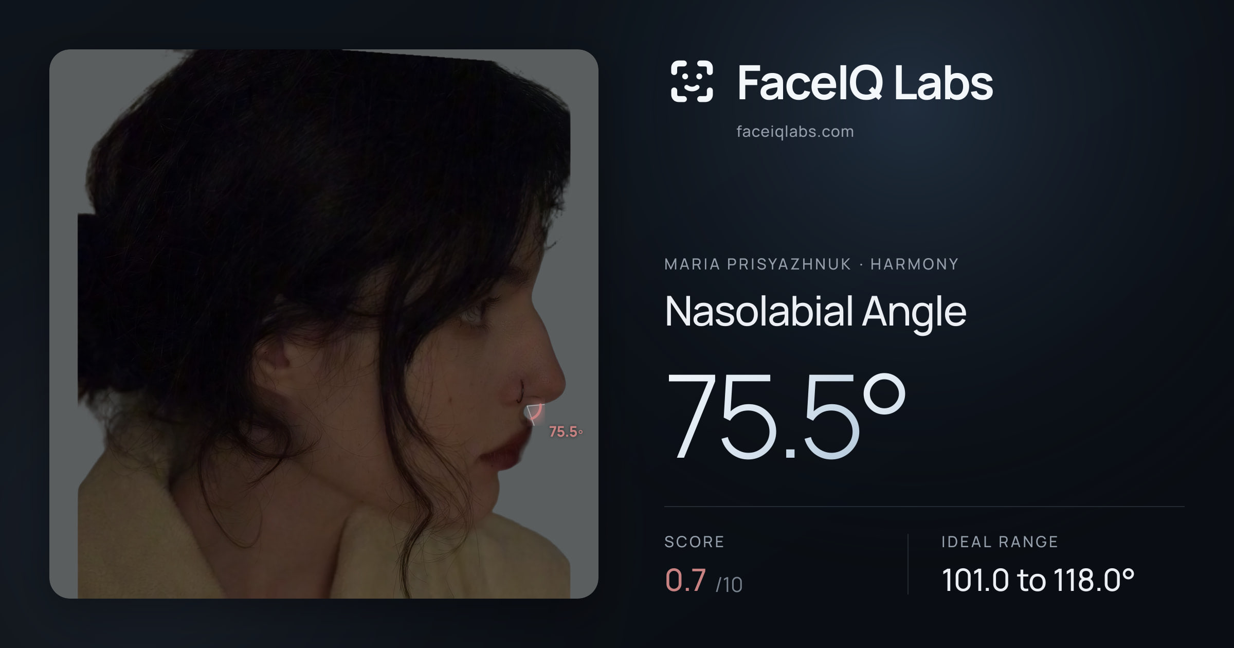 Maria Prisyazhnuk Nasolabial Angle: 75.5°, drawn on the photo