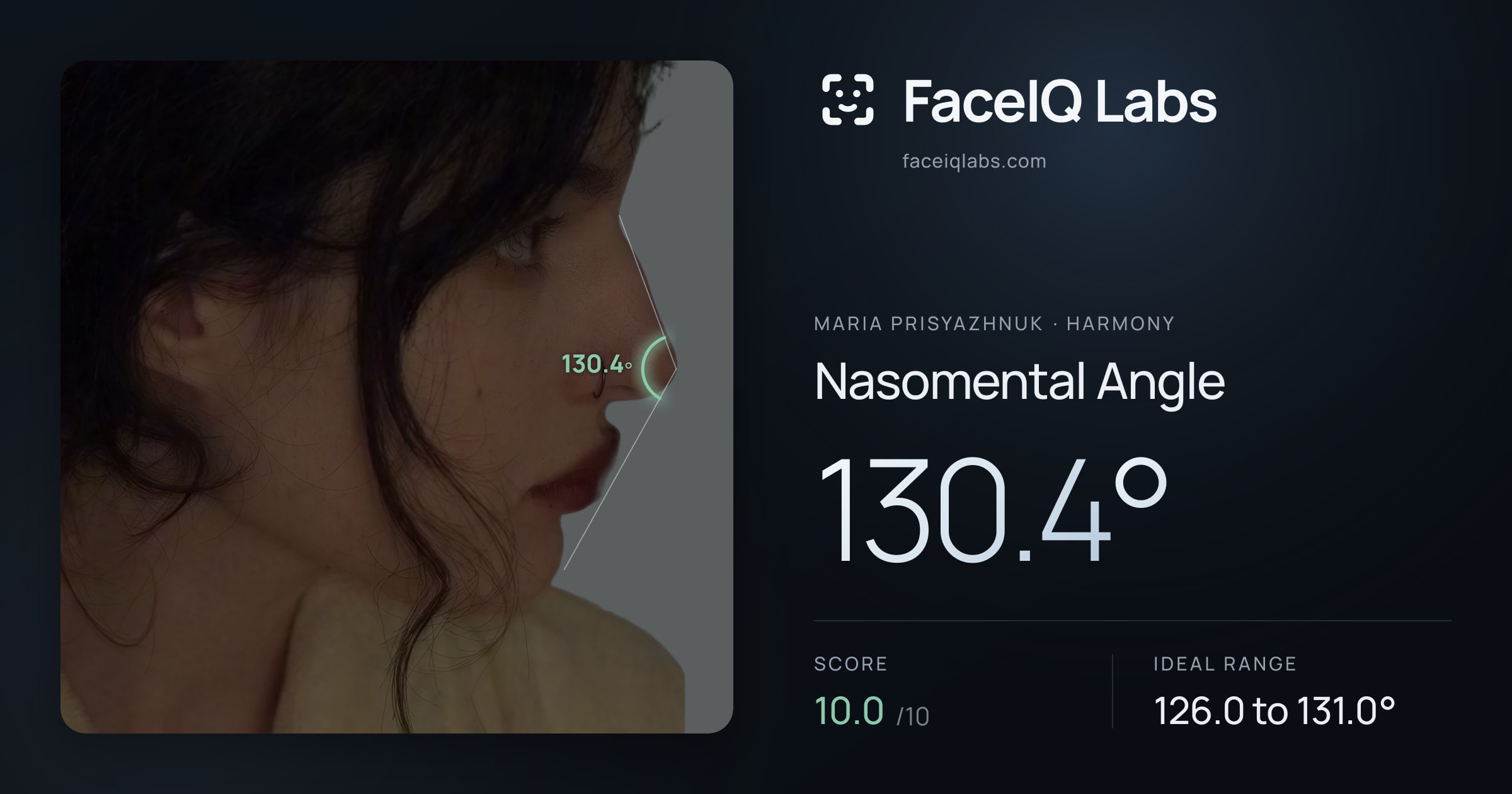 Maria Prisyazhnuk Nasomental Angle: 130.4°, drawn on the photo