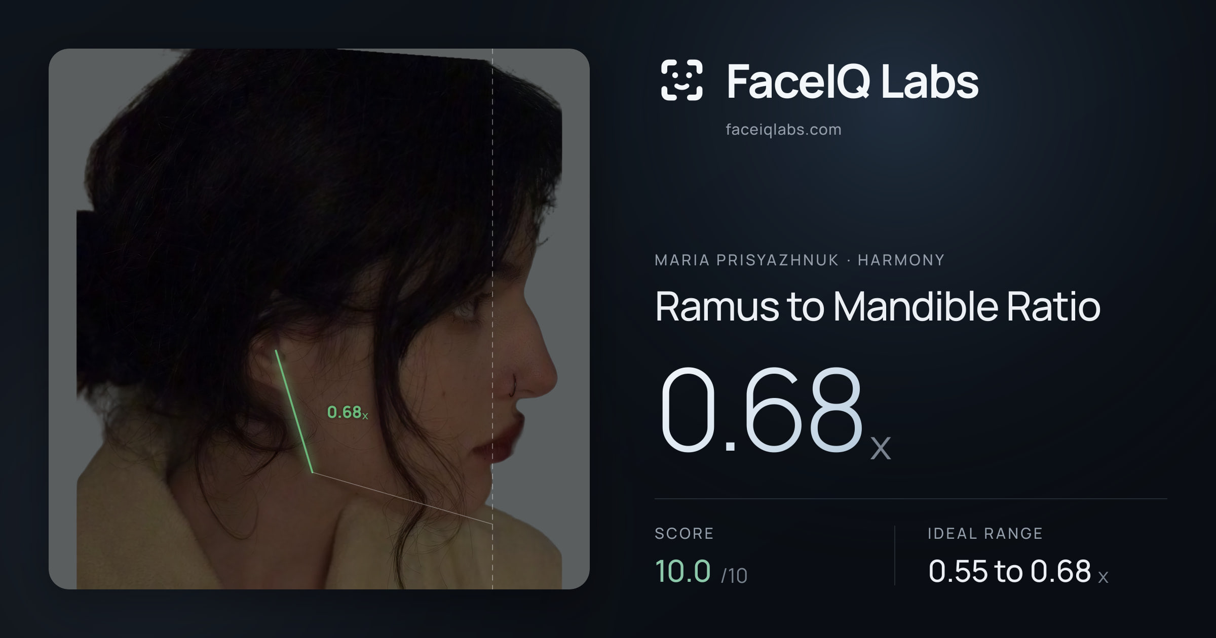 Maria Prisyazhnuk Ramus to Mandible Ratio: 0.68x, drawn on the photo
