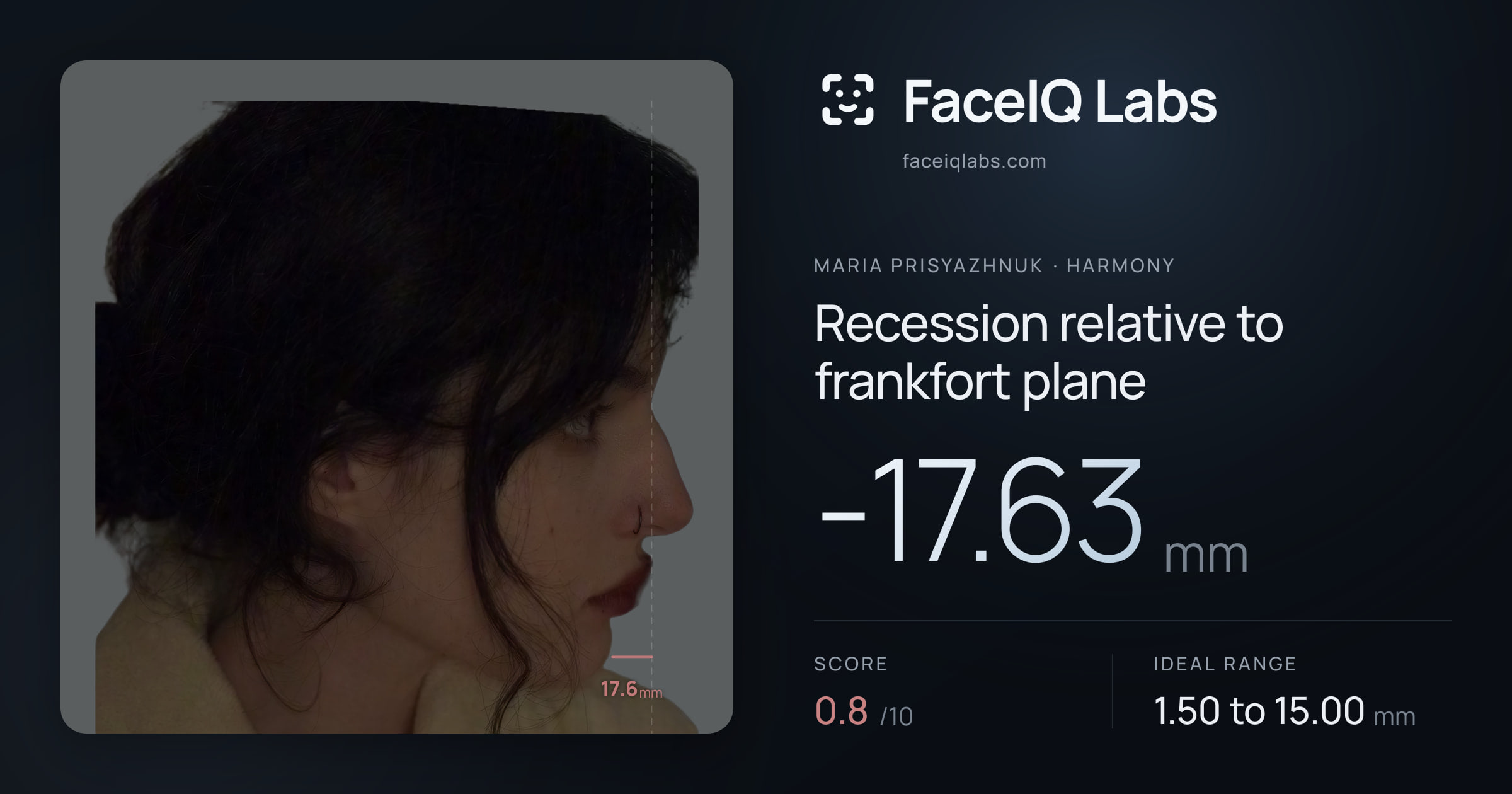 Maria Prisyazhnuk Recession relative to frankfort plane: -17.63mm, drawn on the photo