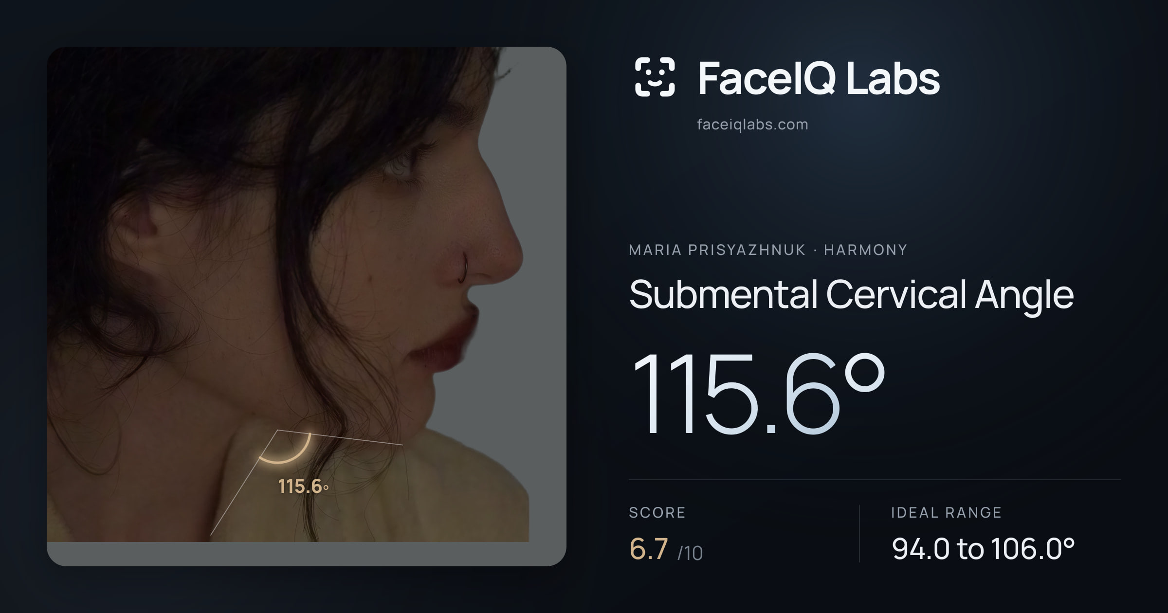 Maria Prisyazhnuk Submental Cervical Angle: 115.6°, drawn on the photo