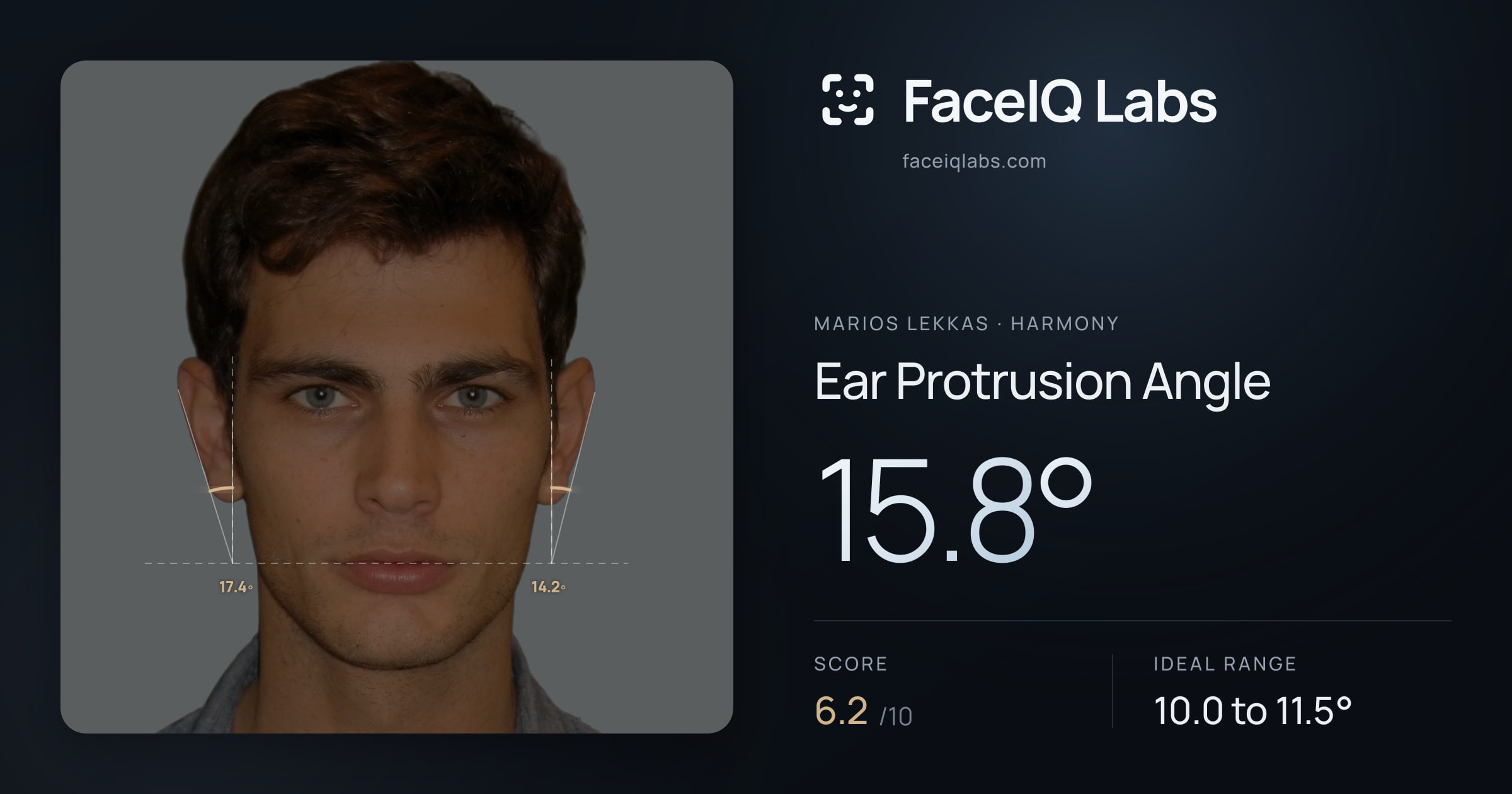 Marios Lekkas Ear Protrusion Angle: 15.8°, drawn on the photo