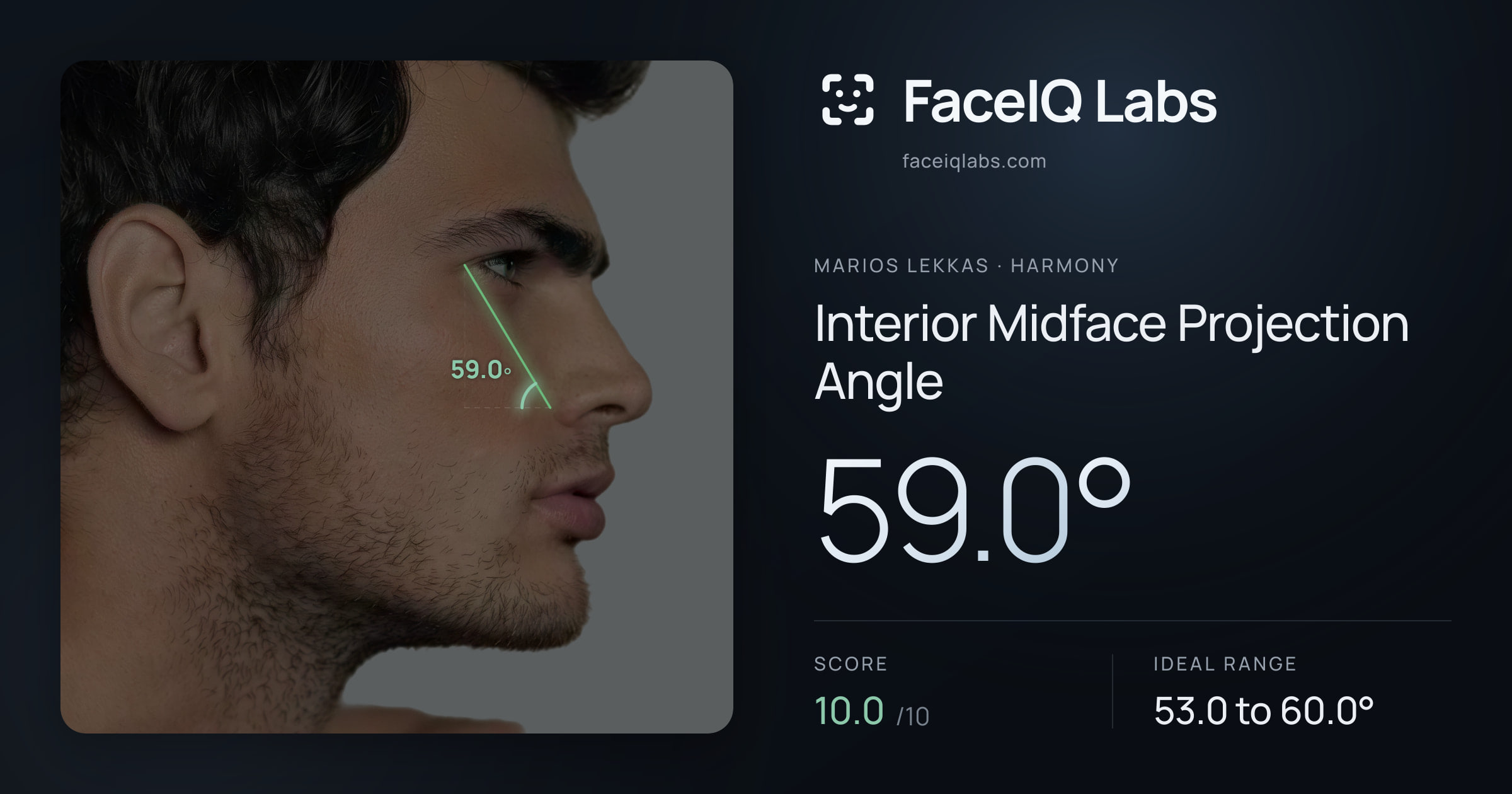 Marios Lekkas Interior Midface Projection Angle: 59.0°, drawn on the photo