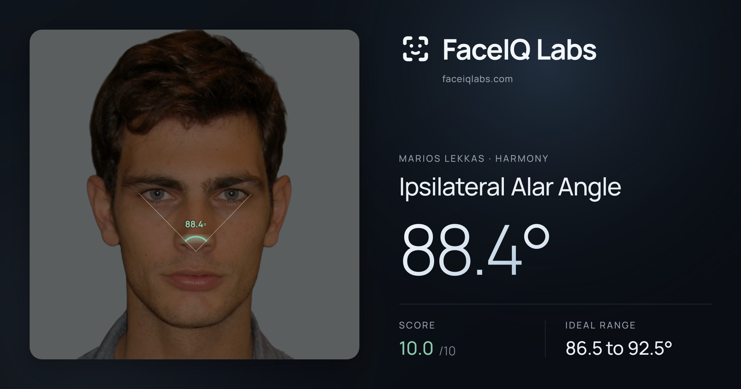 Marios Lekkas Ipsilateral Alar Angle: 88.4°, drawn on the photo