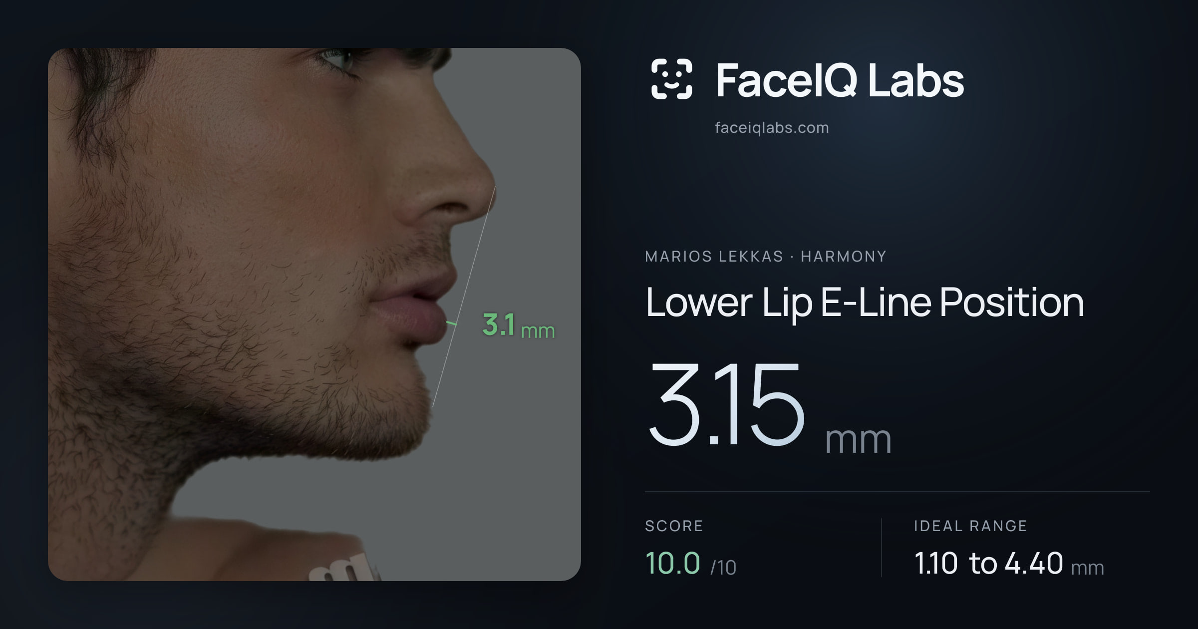 Marios Lekkas Lower Lip E-Line Position: 3.15mm, drawn on the photo