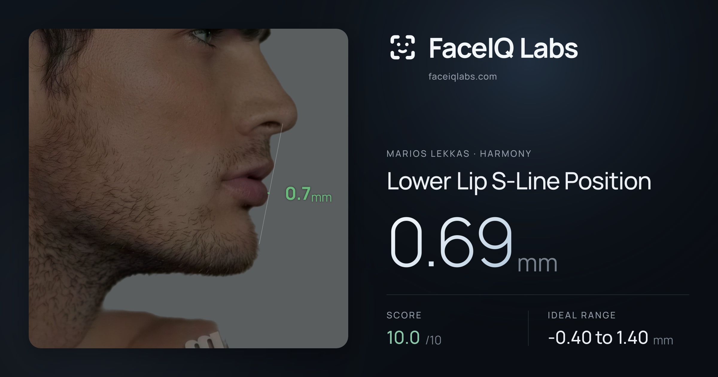 Marios Lekkas Lower Lip S-Line Position: 0.69mm, drawn on the photo