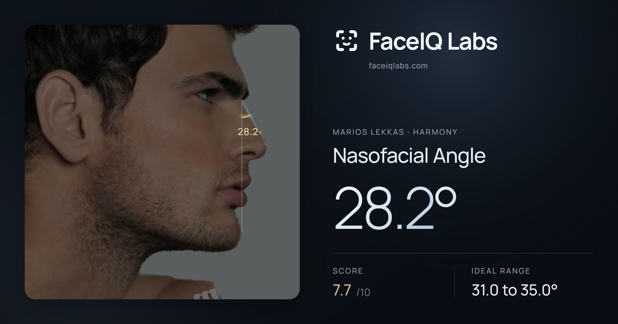 Marios Lekkas Nasofacial Angle: 28.2°, drawn on the photo