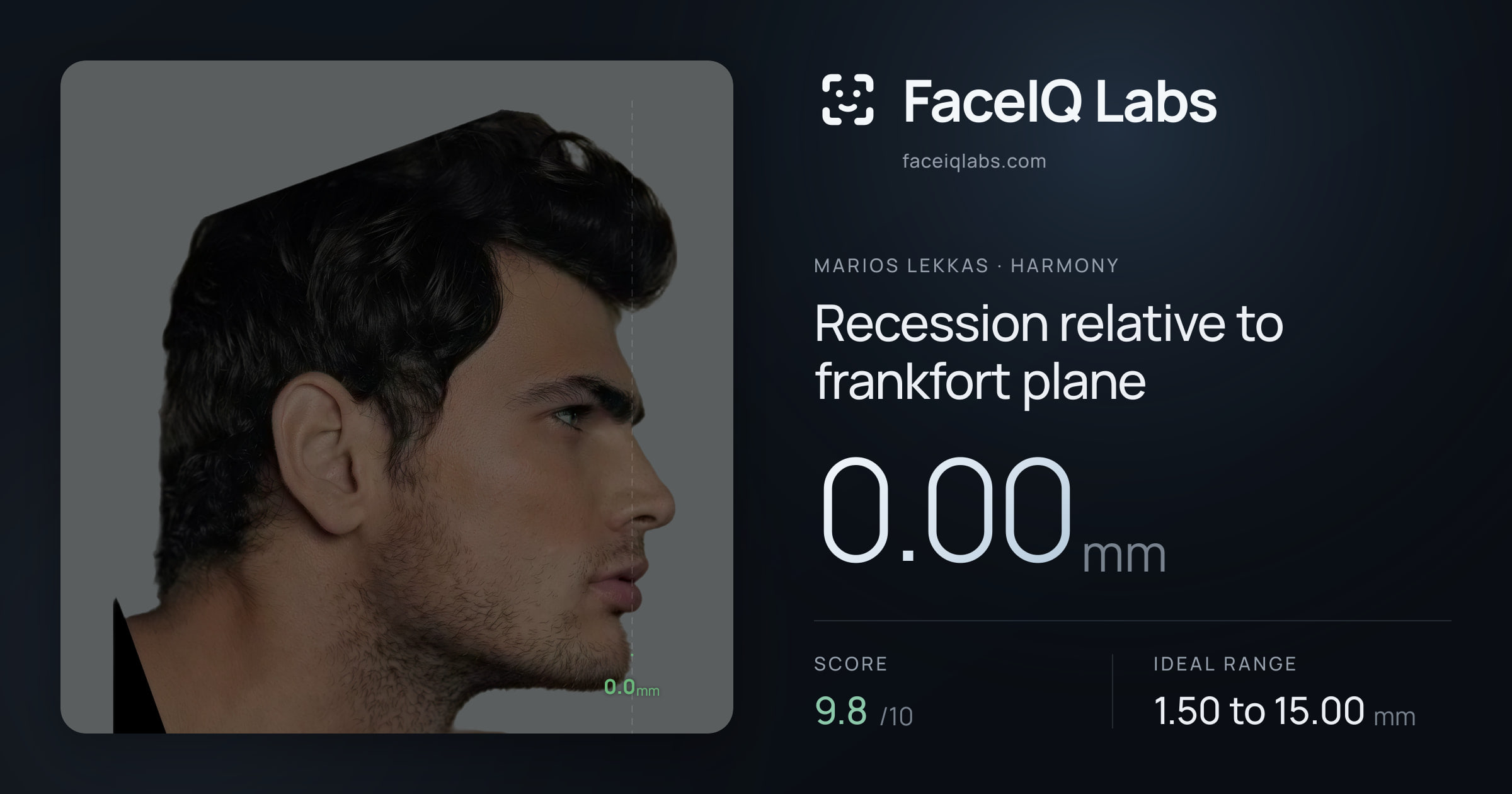 Marios Lekkas Recession relative to frankfort plane: 0.00mm, drawn on the photo
