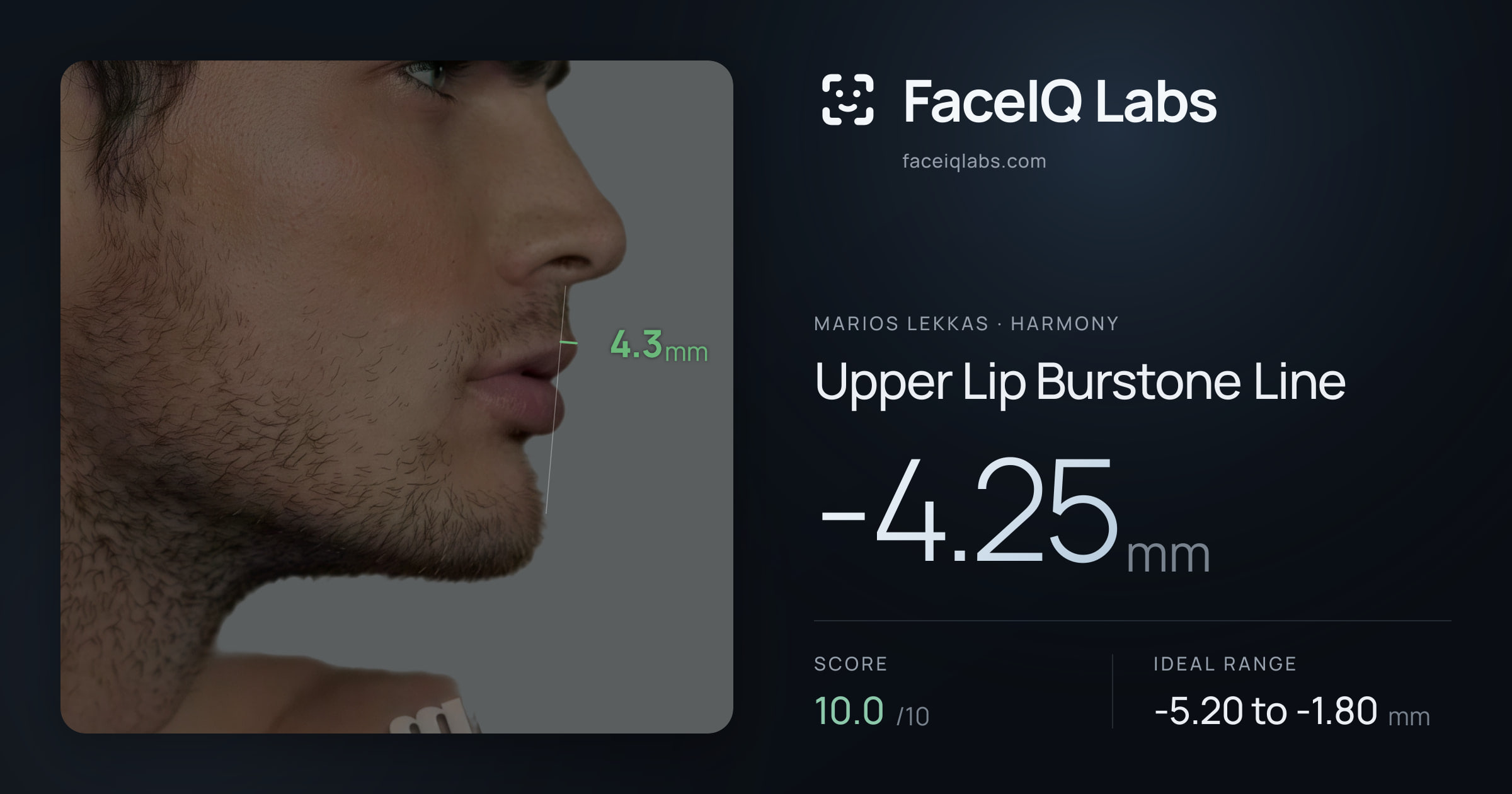 Marios Lekkas Upper Lip Burstone Line: -4.25mm, drawn on the photo