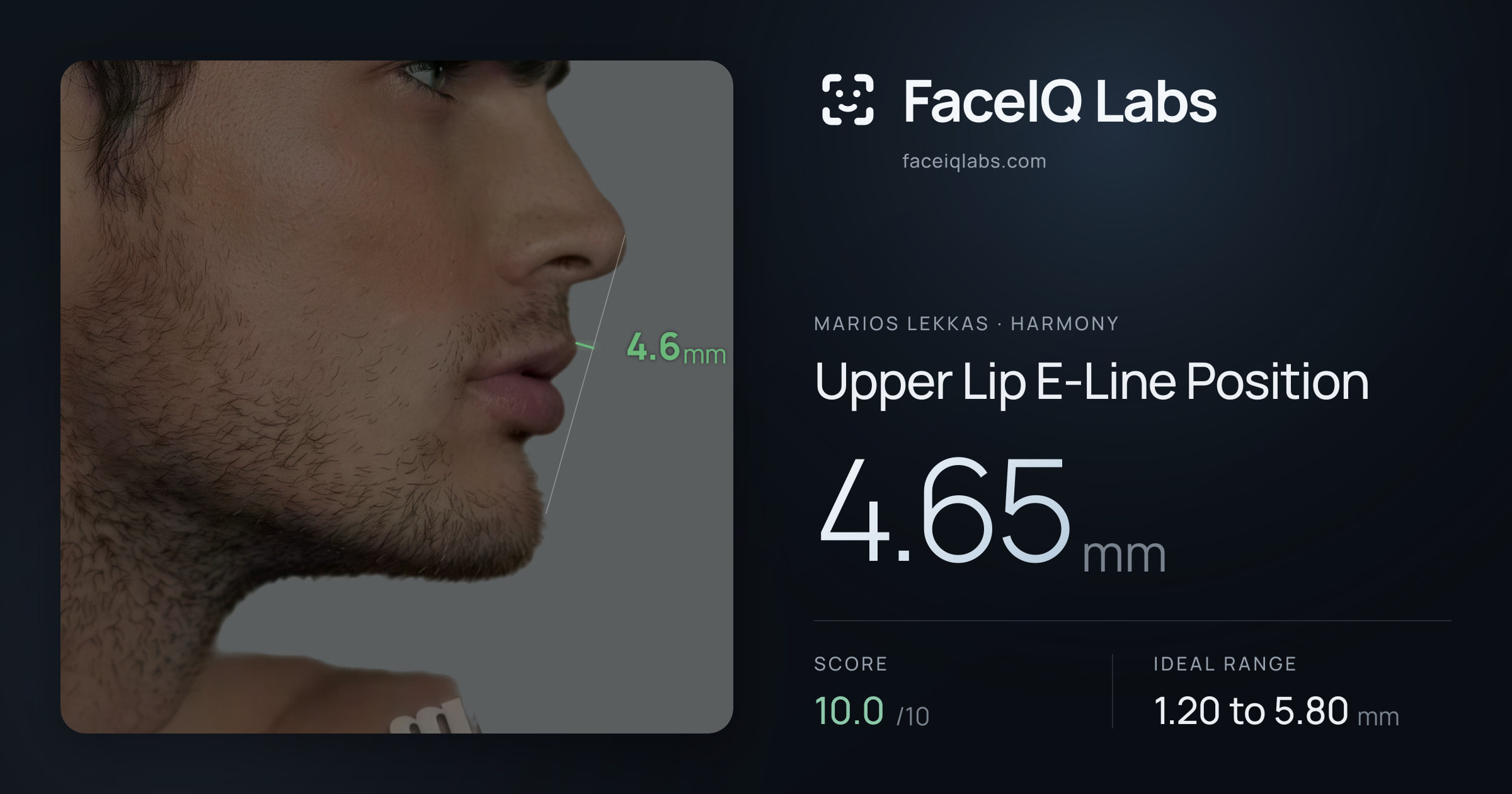 Marios Lekkas Upper Lip E-Line Position: 4.65mm, drawn on the photo