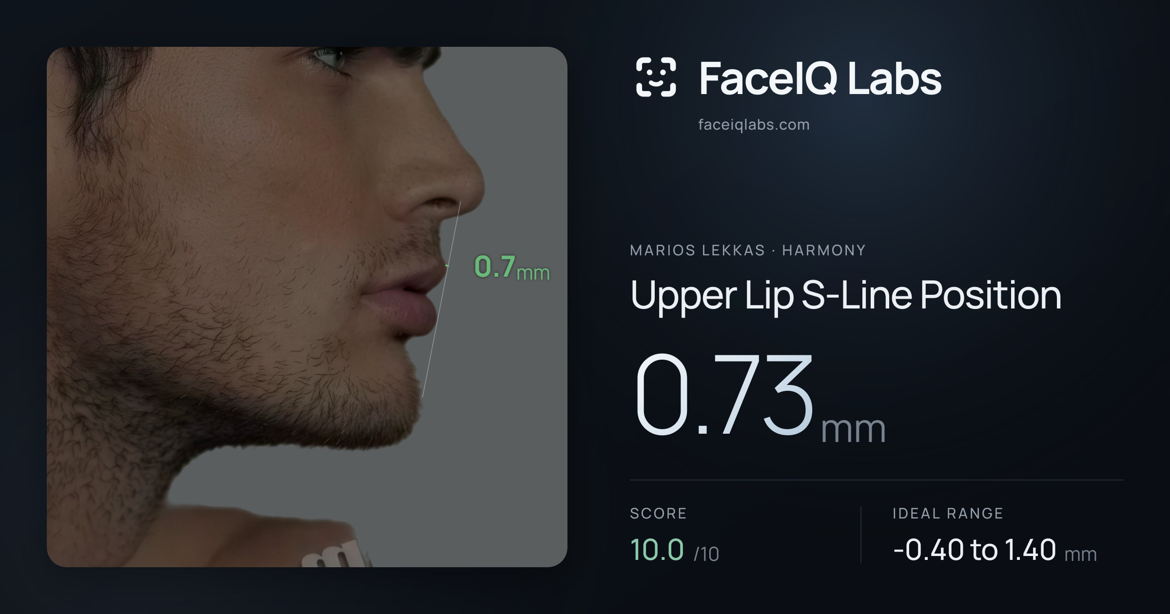 Marios Lekkas Upper Lip S-Line Position: 0.73mm, drawn on the photo