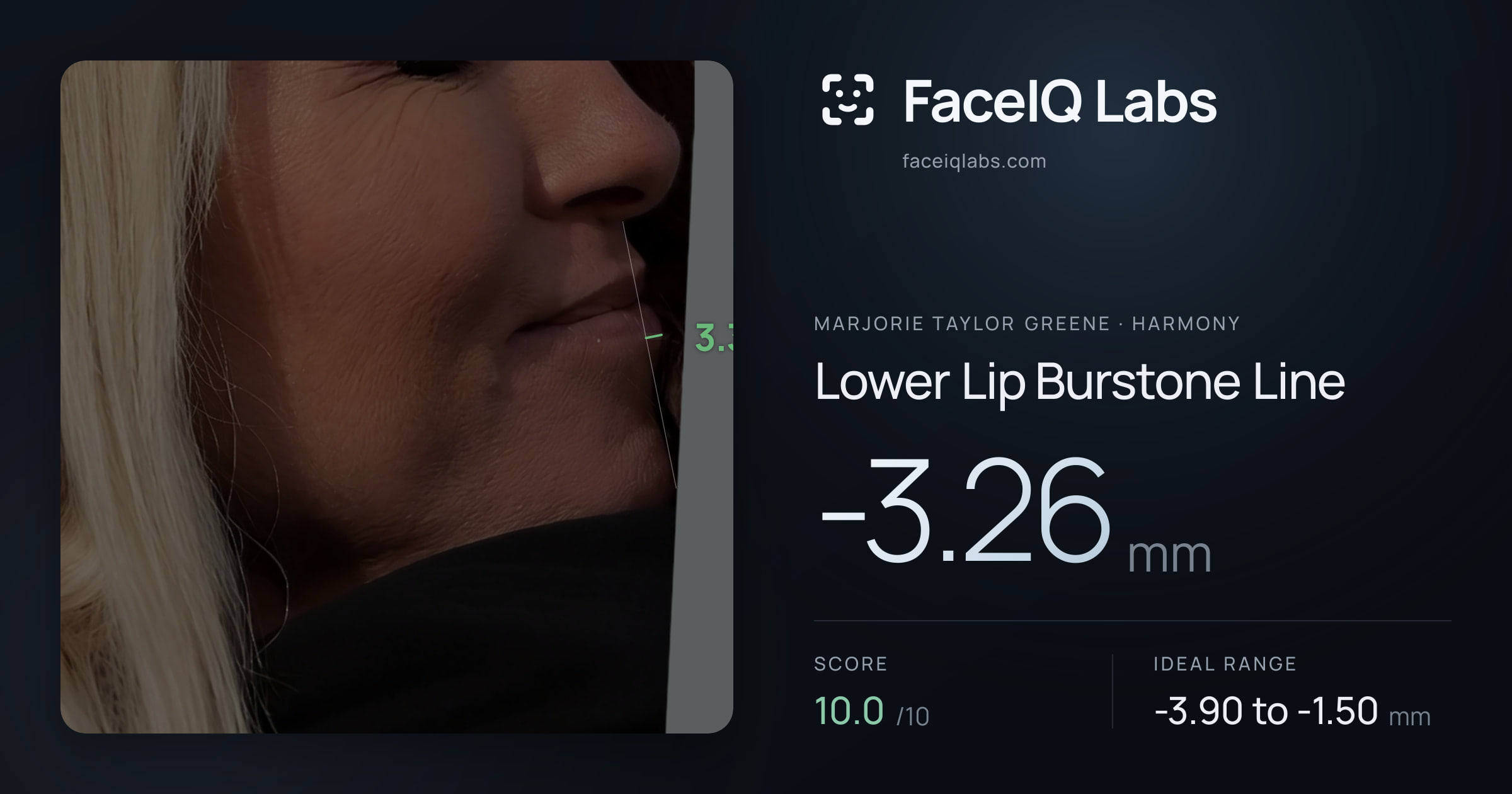 Marjorie Taylor Greene Lower Lip Burstone Line: -3.26mm, drawn on the photo