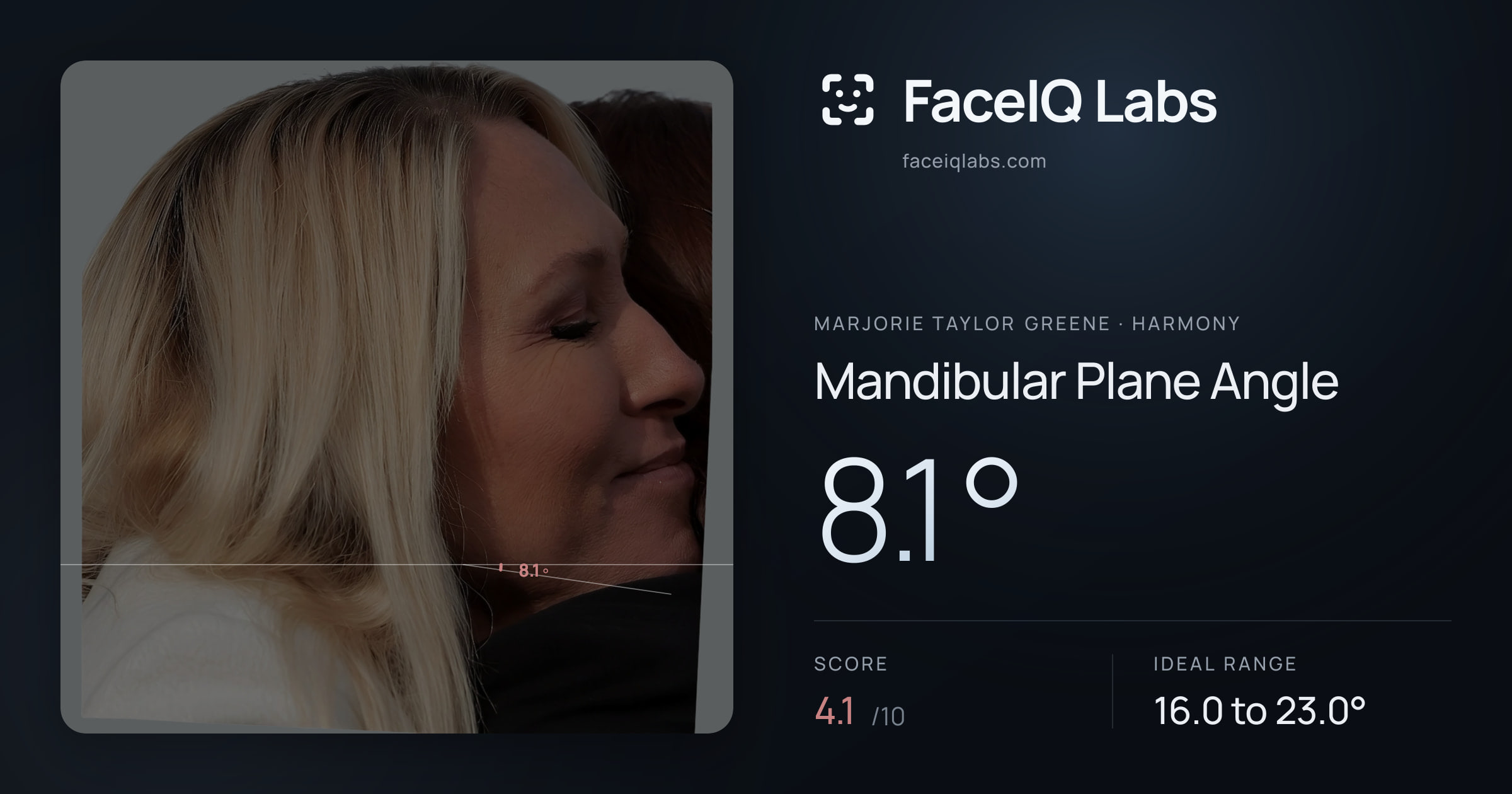 Marjorie Taylor Greene Mandibular Plane Angle: 8.1°, drawn on the photo
