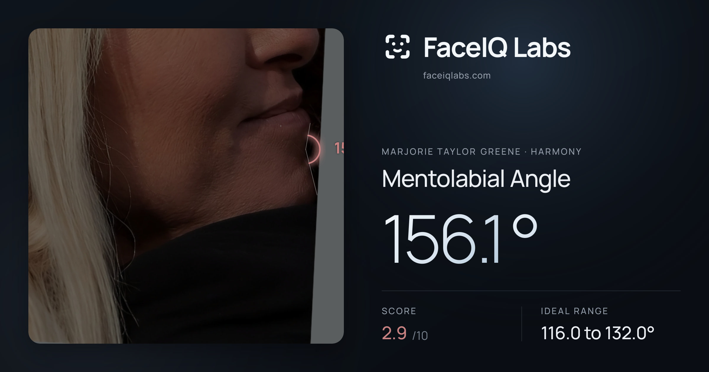 Marjorie Taylor Greene Mentolabial Angle: 156.1°, drawn on the photo