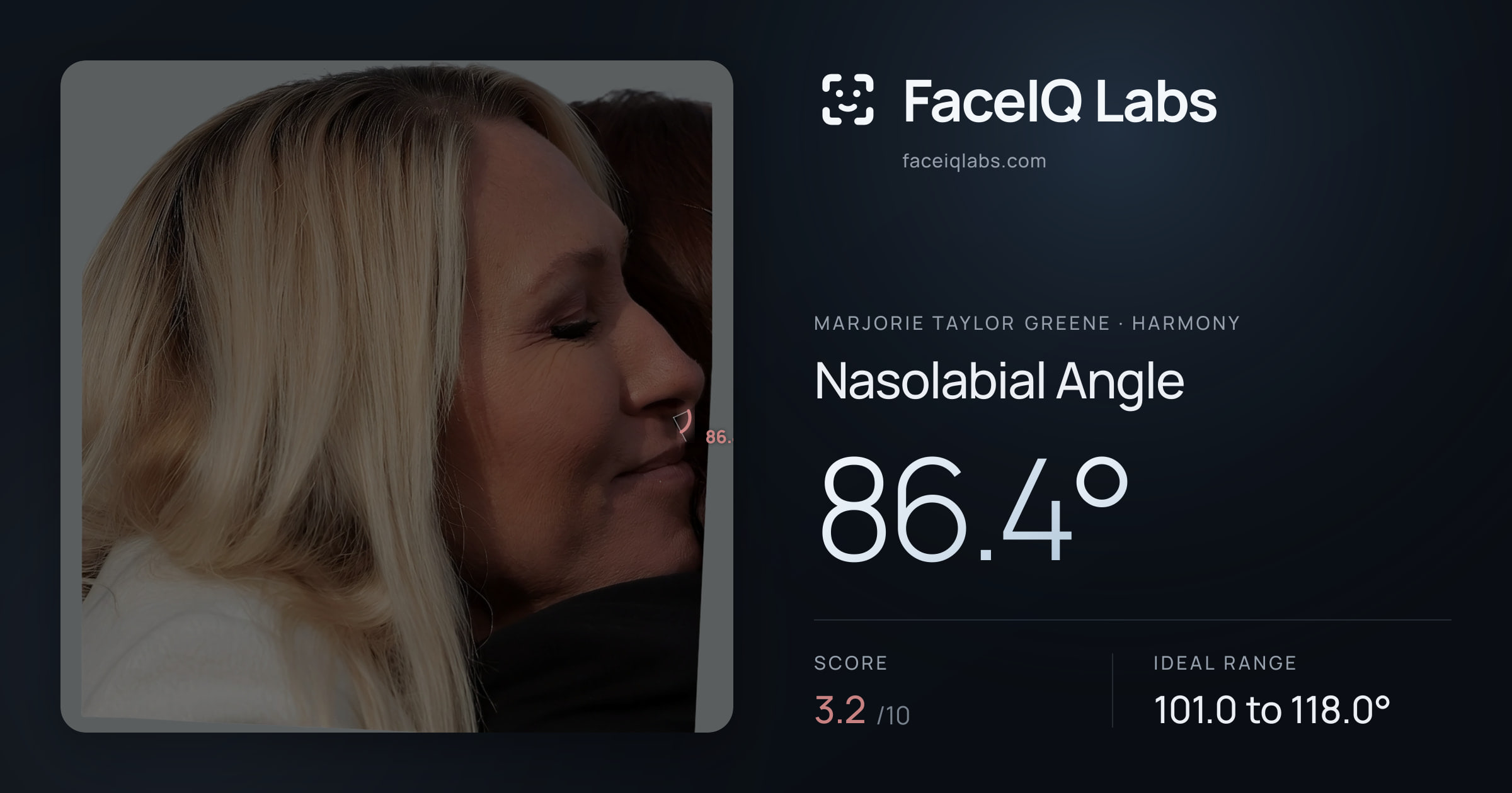 Marjorie Taylor Greene Nasolabial Angle: 86.4°, drawn on the photo