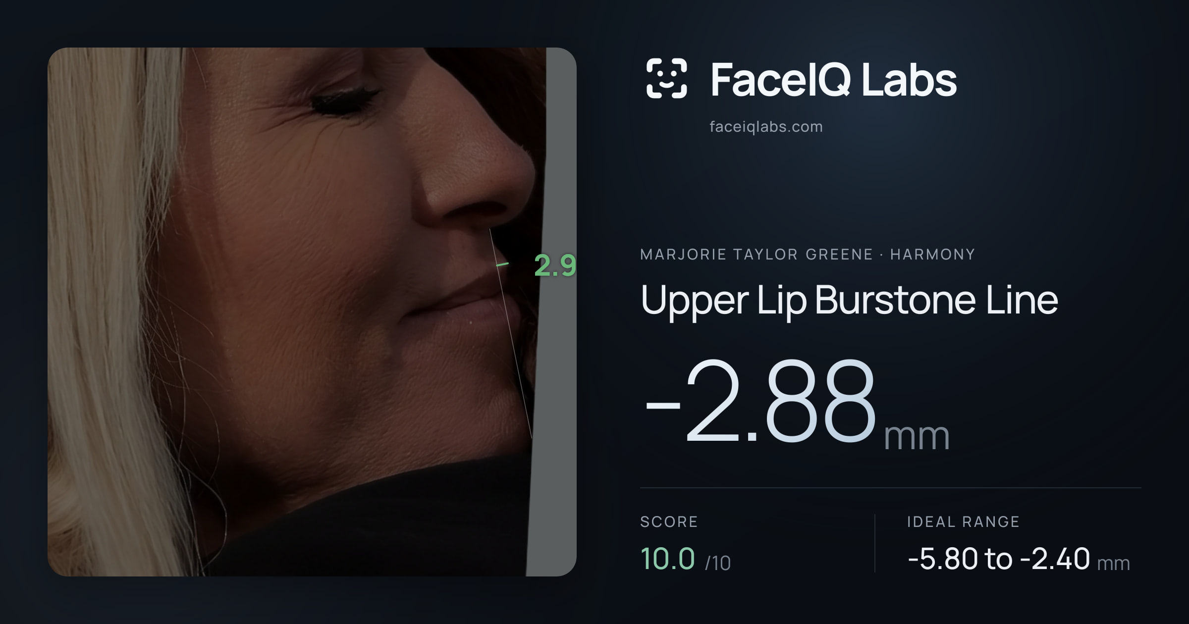 Marjorie Taylor Greene Upper Lip Burstone Line: -2.88mm, drawn on the photo