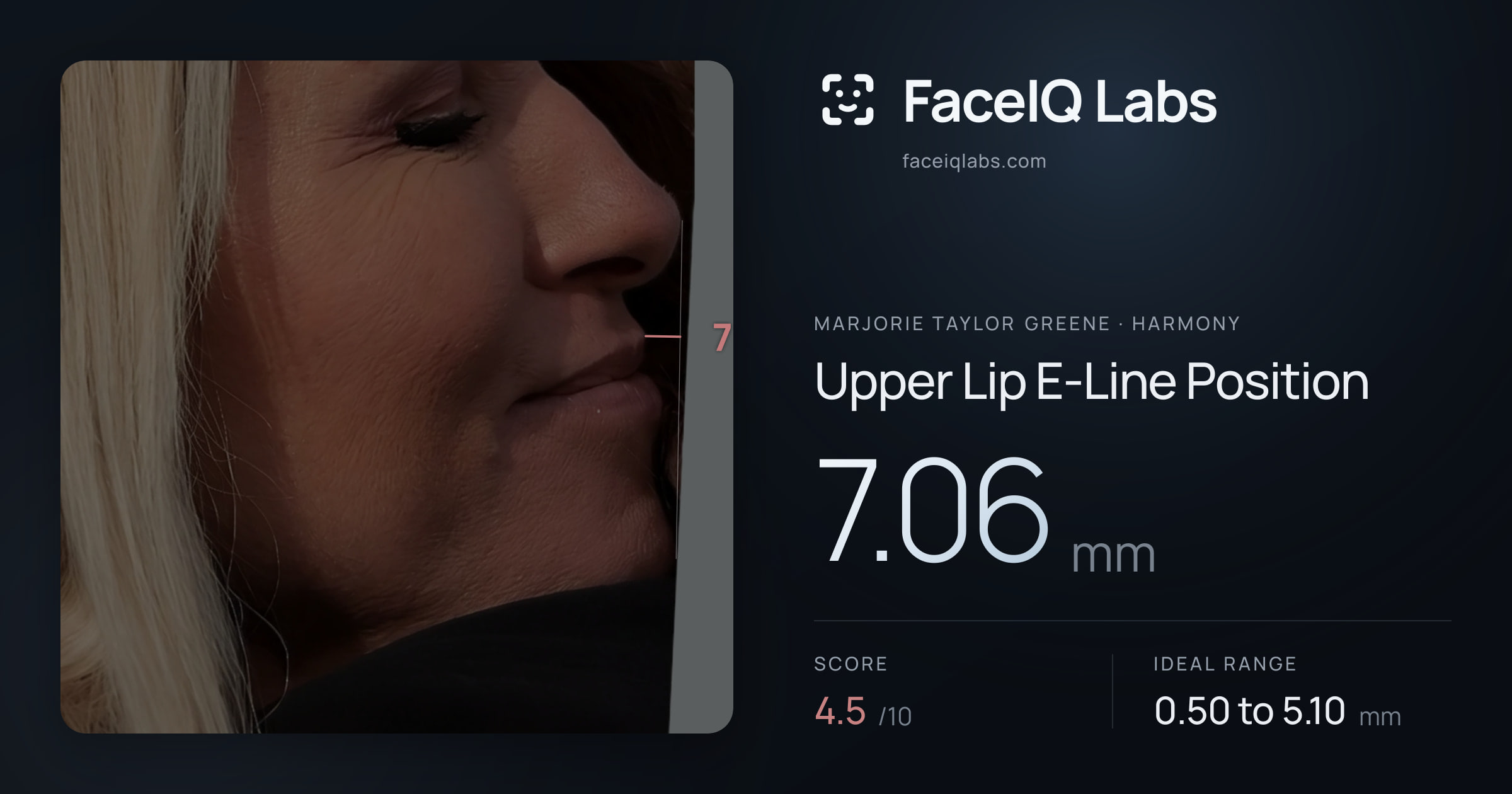 Marjorie Taylor Greene Upper Lip E-Line Position: 7.06mm, drawn on the photo