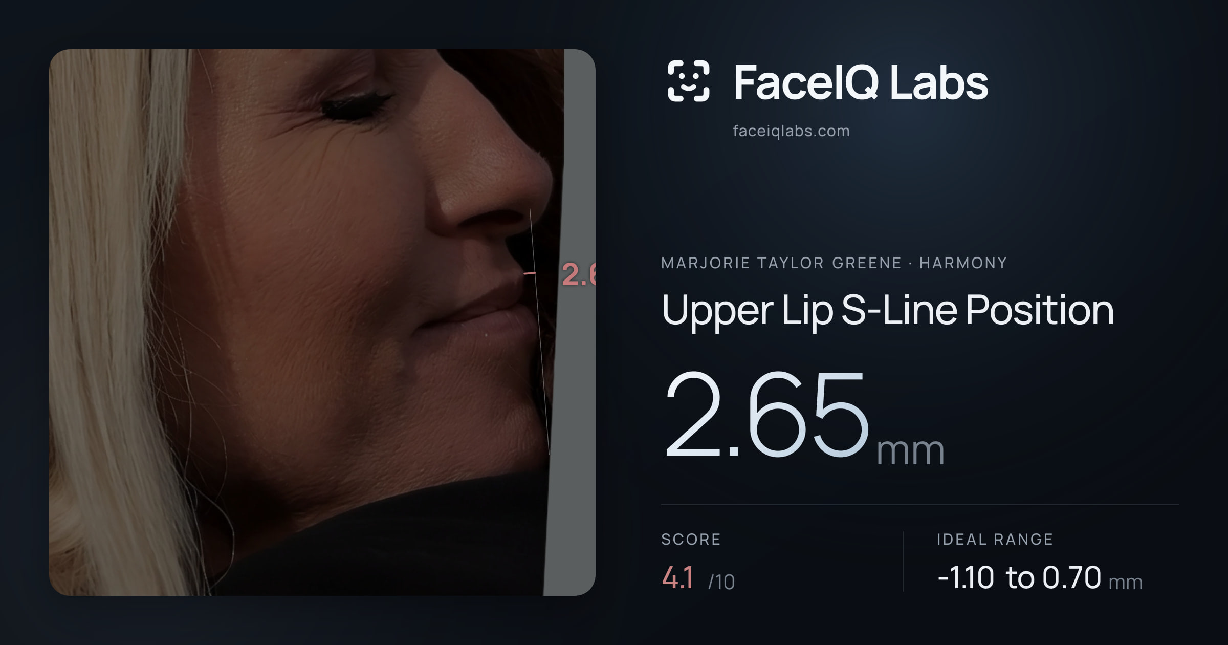 Marjorie Taylor Greene Upper Lip S-Line Position: 2.65mm, drawn on the photo
