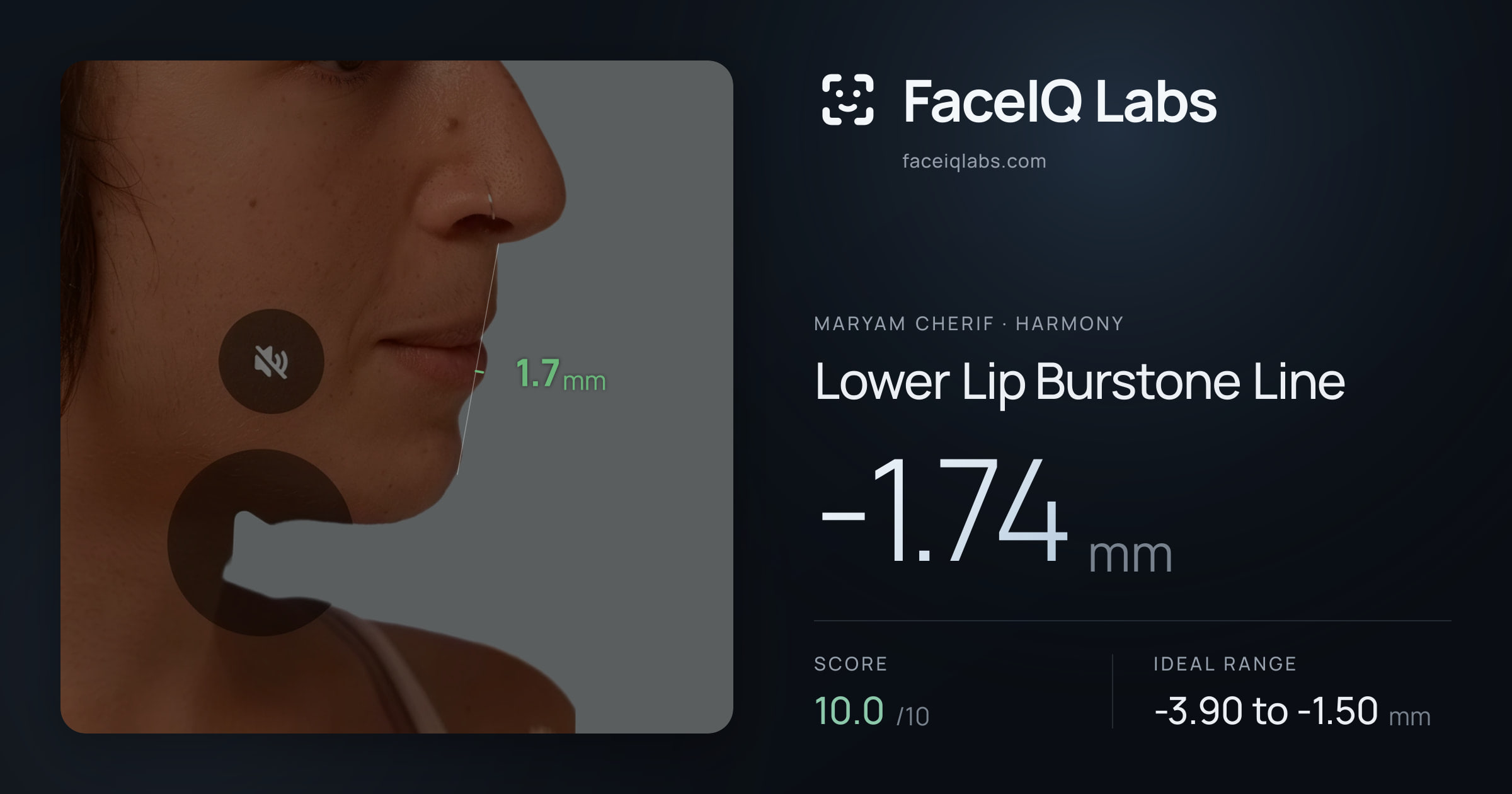 Maryam Cherif Lower Lip Burstone Line: -1.74mm, drawn on the photo