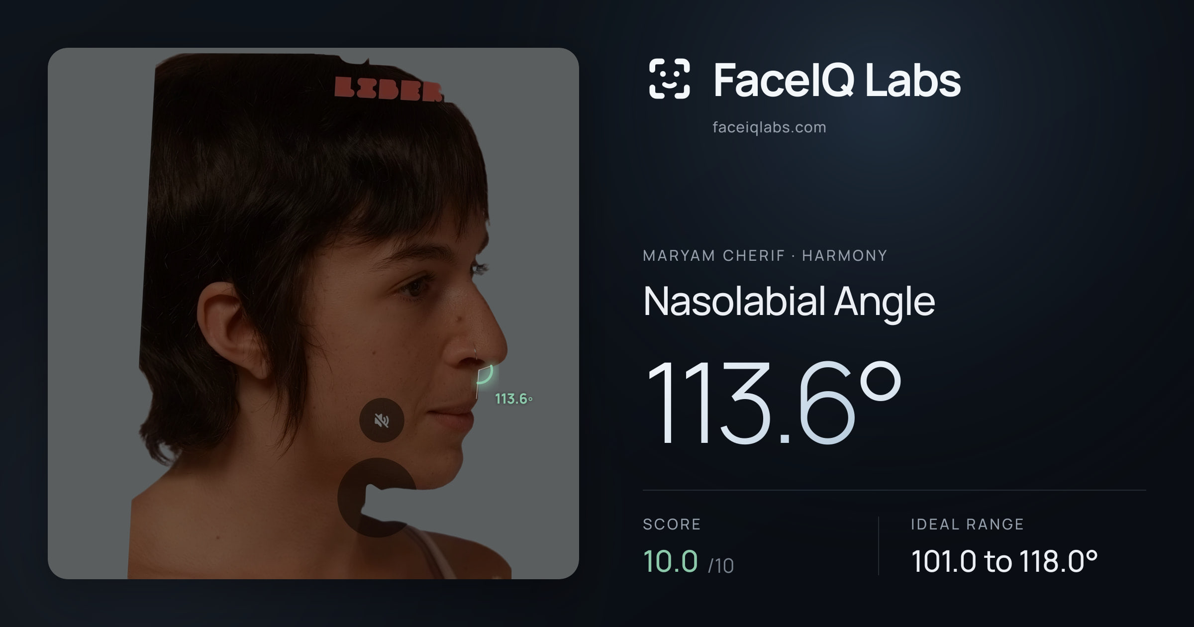 Maryam Cherif Nasolabial Angle: 113.6°, drawn on the photo