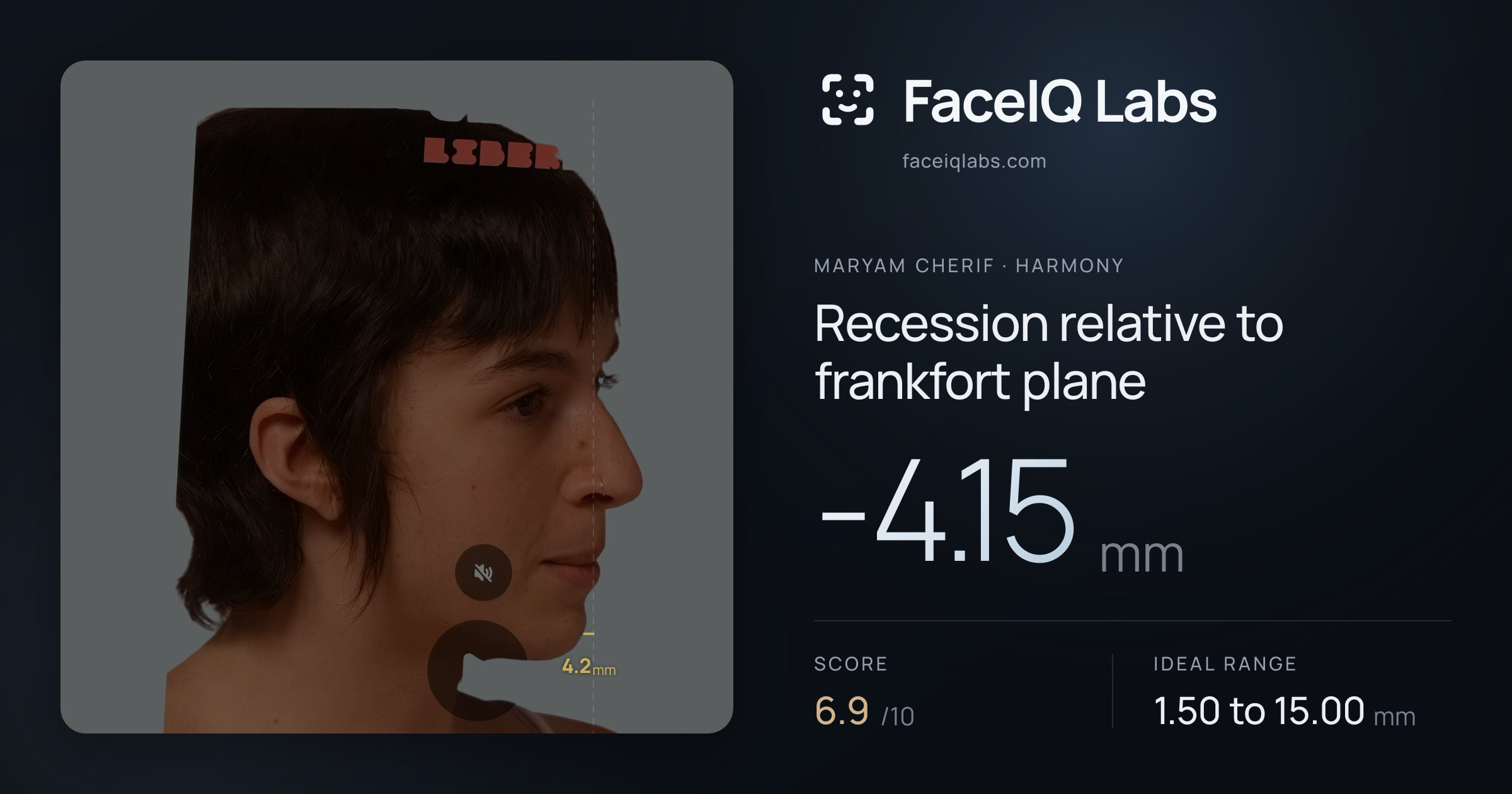Maryam Cherif Recession relative to frankfort plane: -4.15mm, drawn on the photo