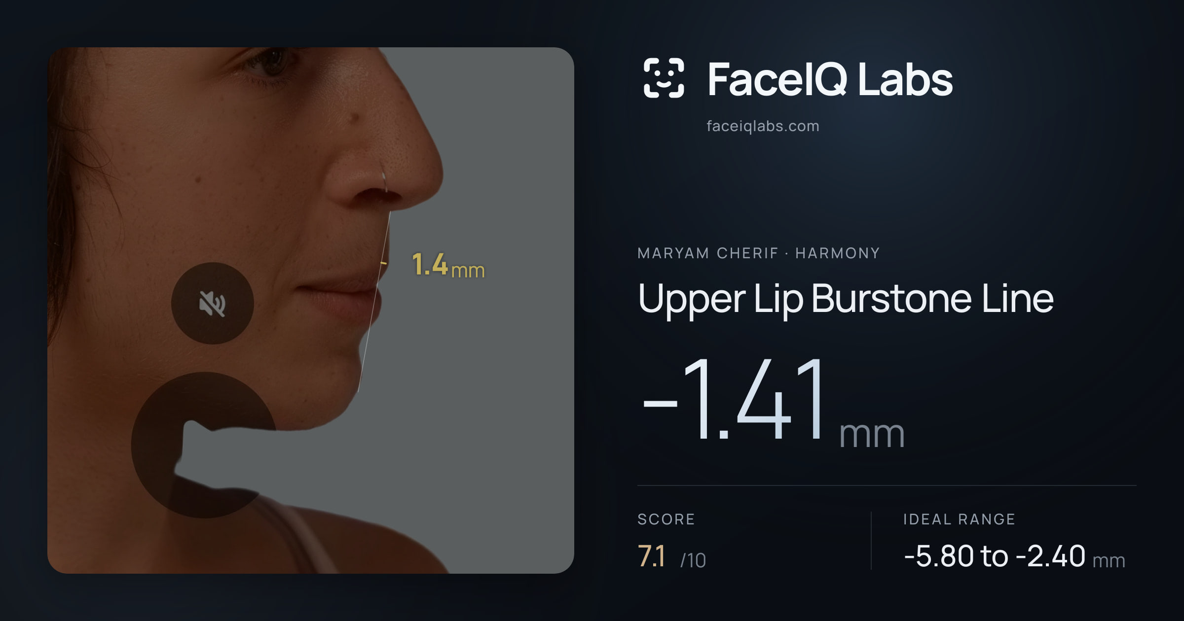 Maryam Cherif Upper Lip Burstone Line: -1.41mm, drawn on the photo