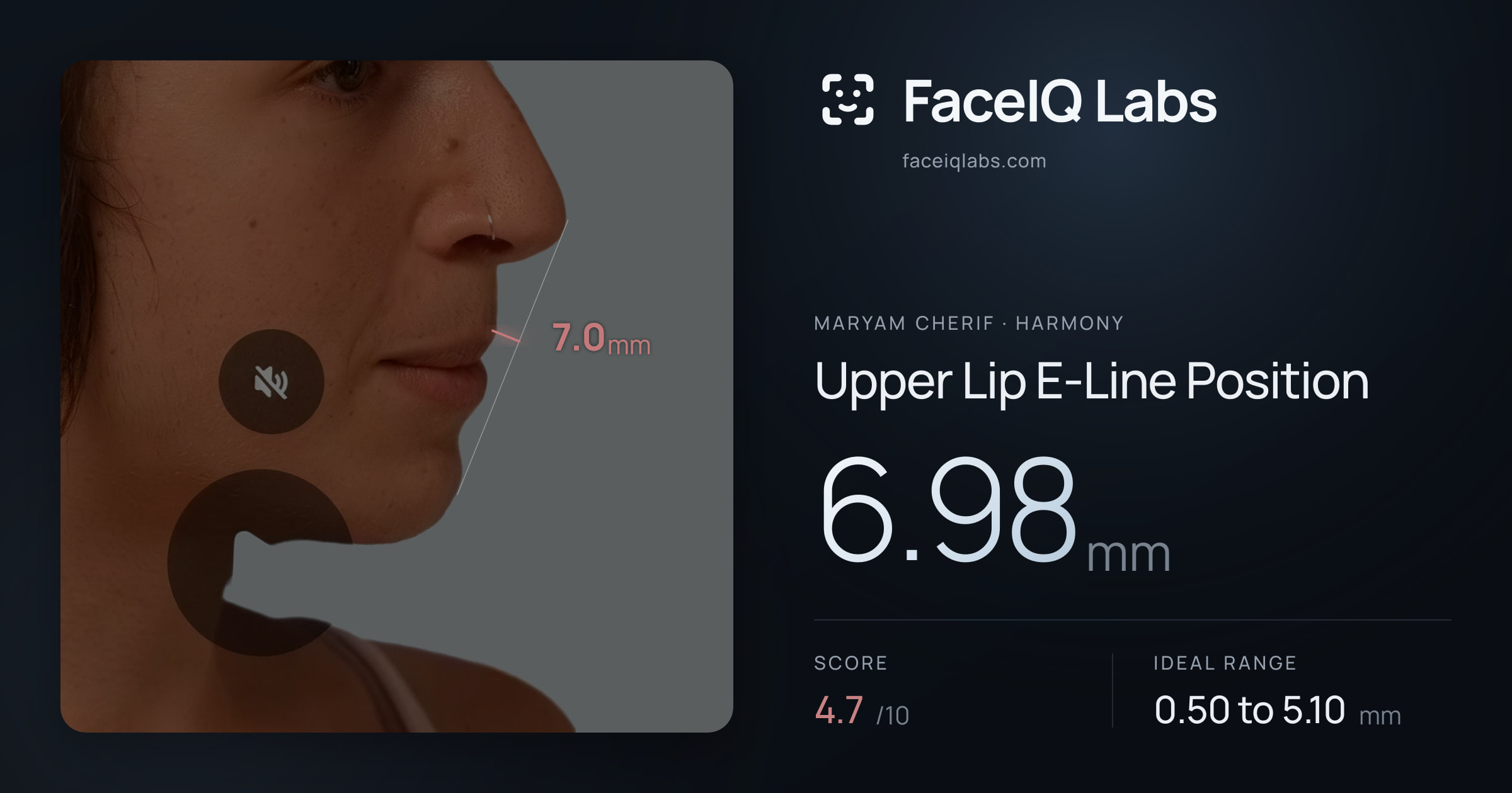 Maryam Cherif Upper Lip E-Line Position: 6.98mm, drawn on the photo