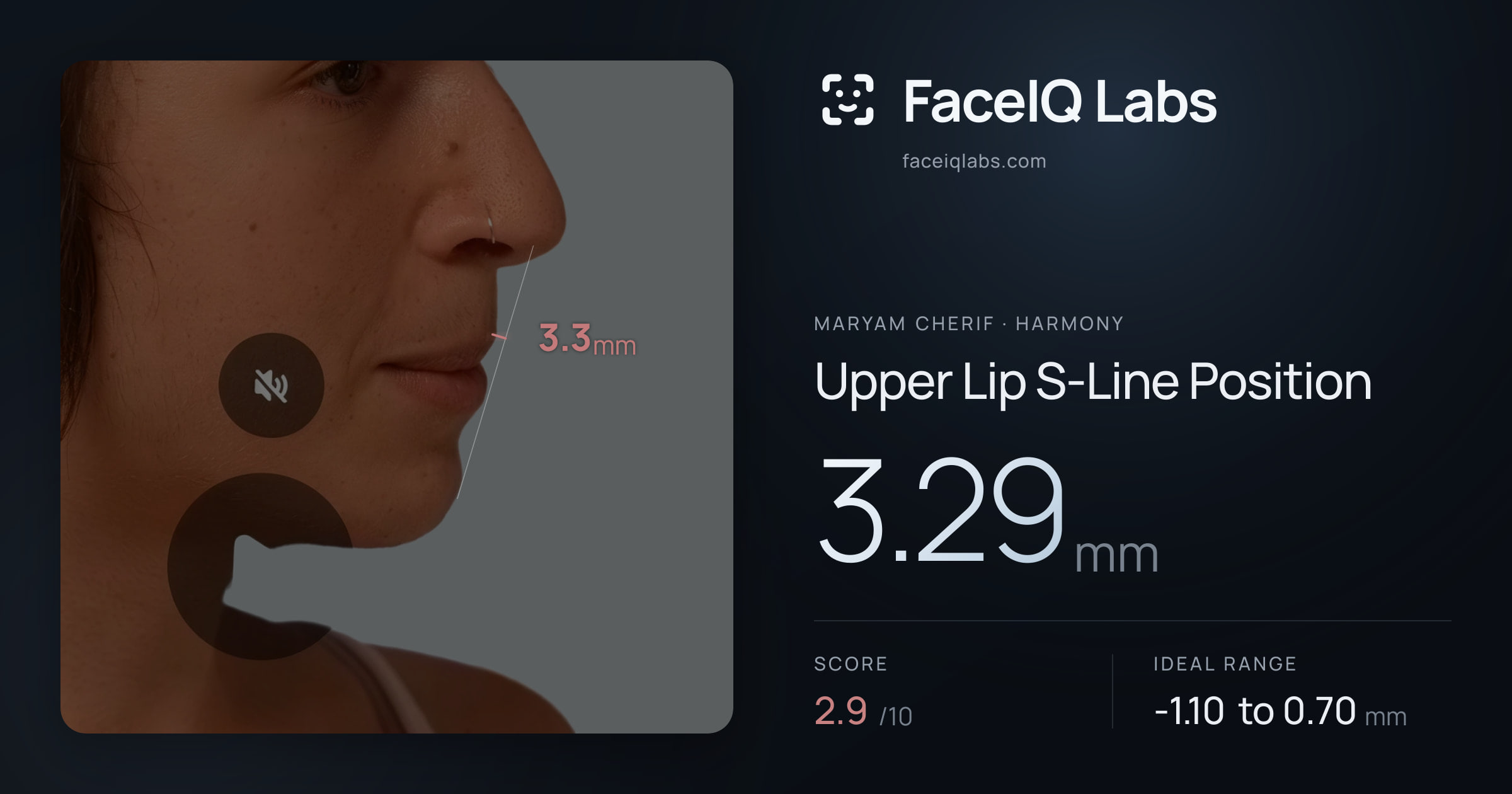 Maryam Cherif Upper Lip S-Line Position: 3.29mm, drawn on the photo
