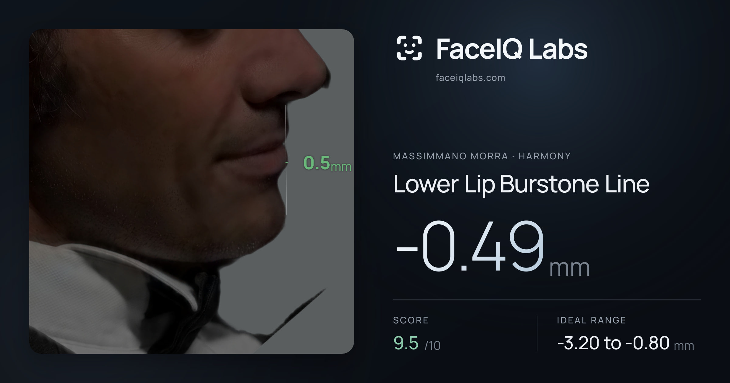 Massimmano Morra Lower Lip Burstone Line: -0.49mm, drawn on the photo