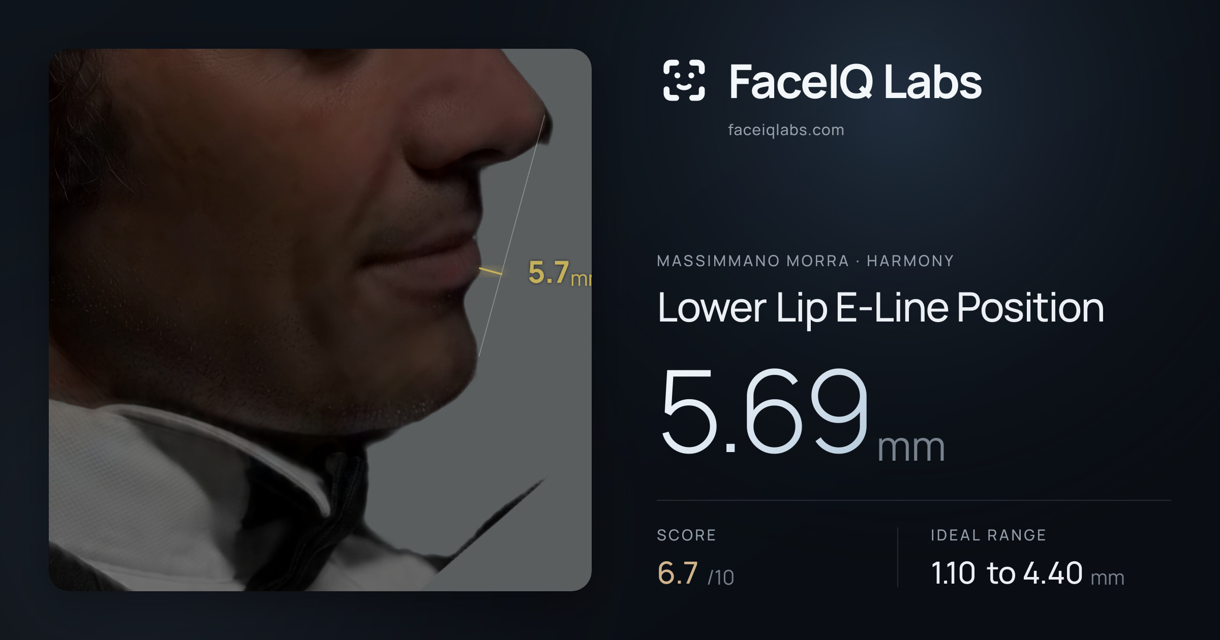 Massimmano Morra Lower Lip E-Line Position: 5.69mm, drawn on the photo