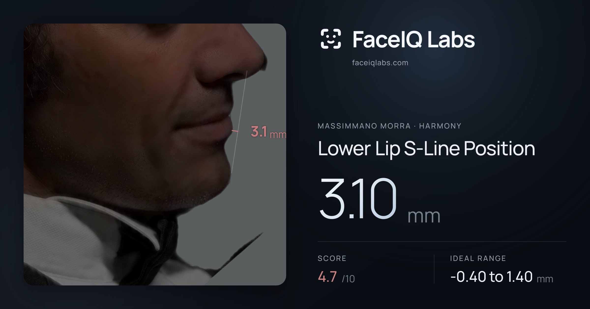 Massimmano Morra Lower Lip S-Line Position: 3.10mm, drawn on the photo