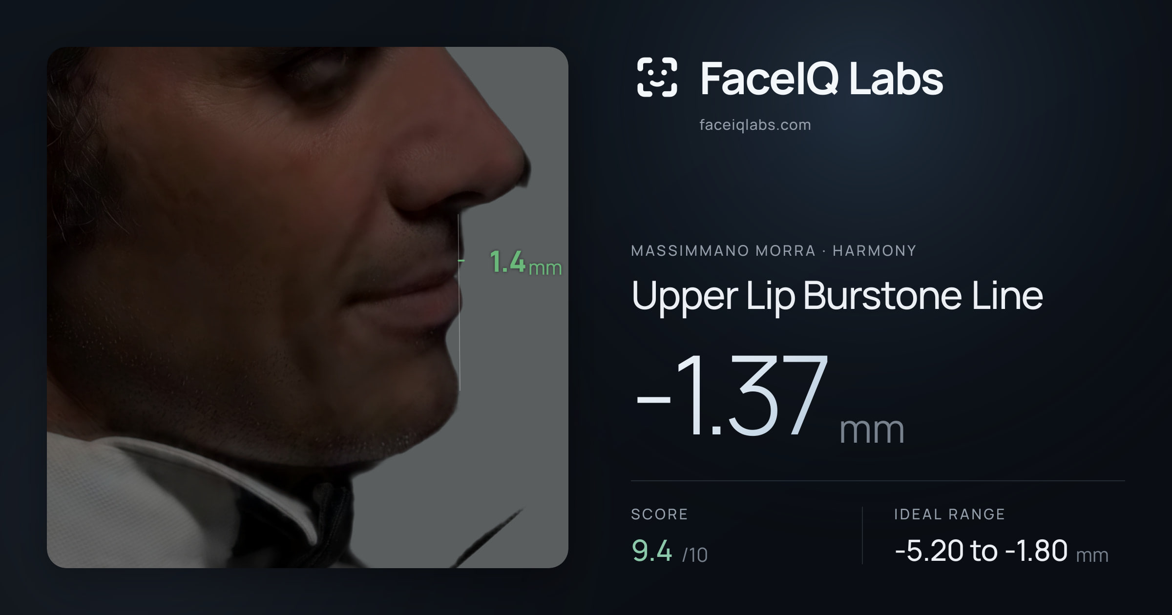 Massimmano Morra Upper Lip Burstone Line: -1.37mm, drawn on the photo