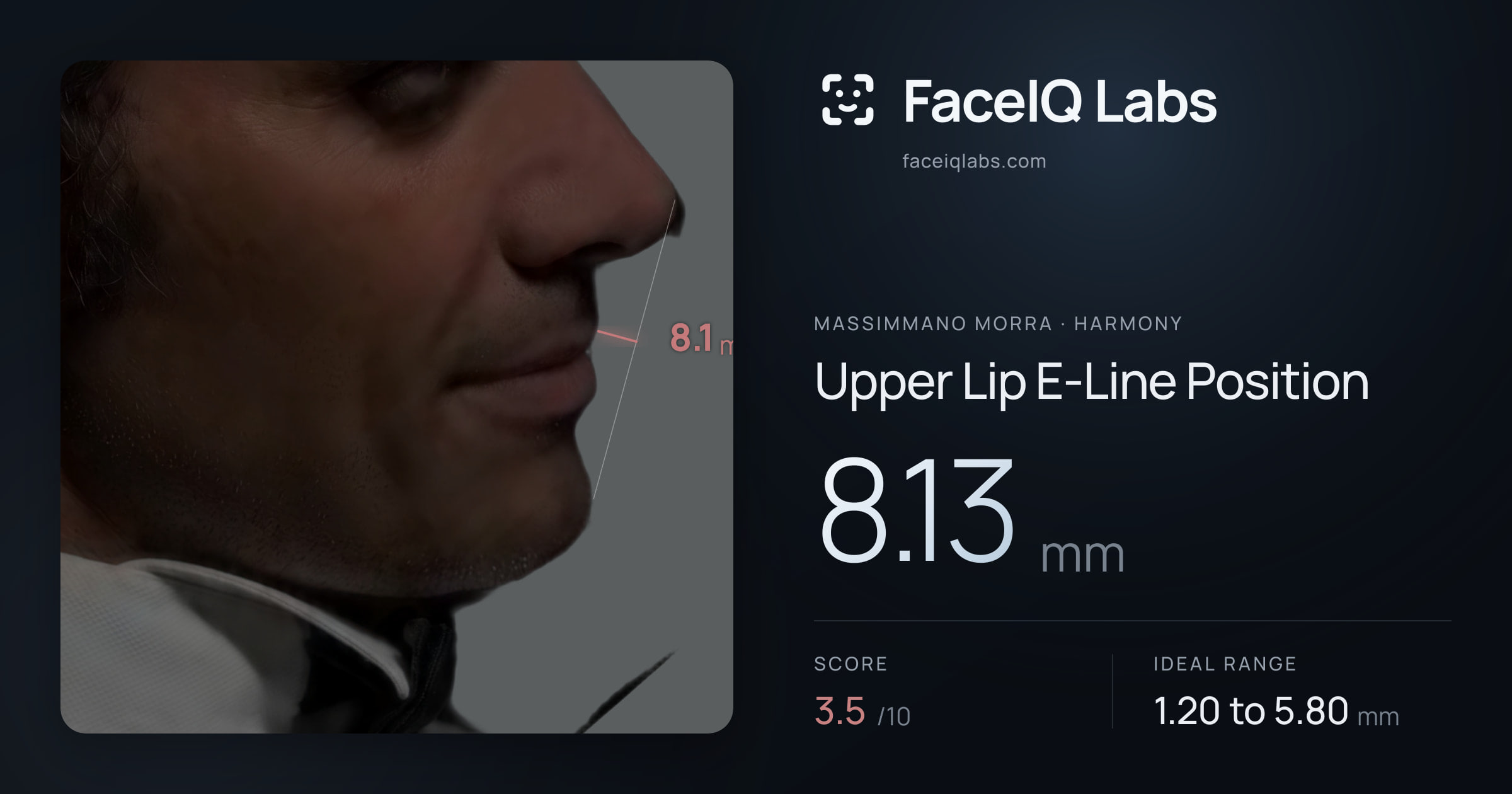 Massimmano Morra Upper Lip E-Line Position: 8.13mm, drawn on the photo