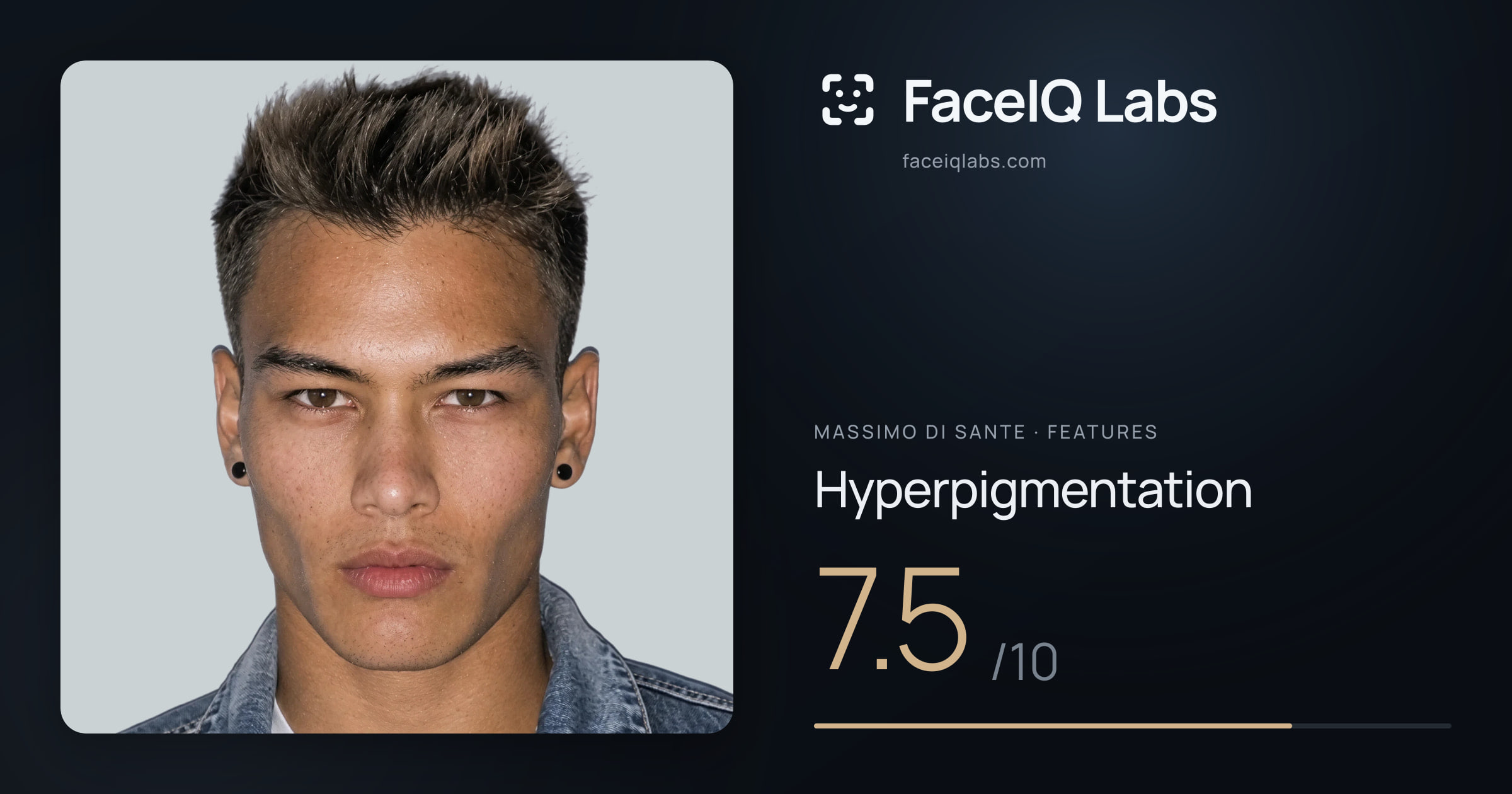 Massimo di Sante Hyperpigmentation: 7.5/10, drawn on the photo
