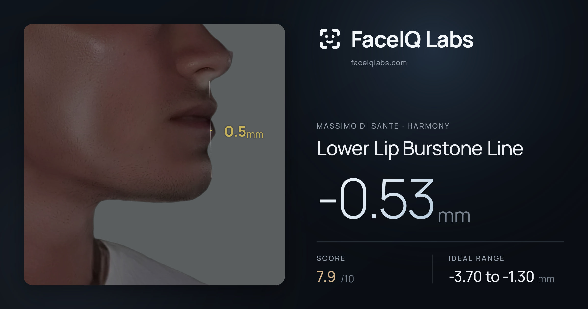 Massimo di Sante Lower Lip Burstone Line: -0.53mm, drawn on the photo
