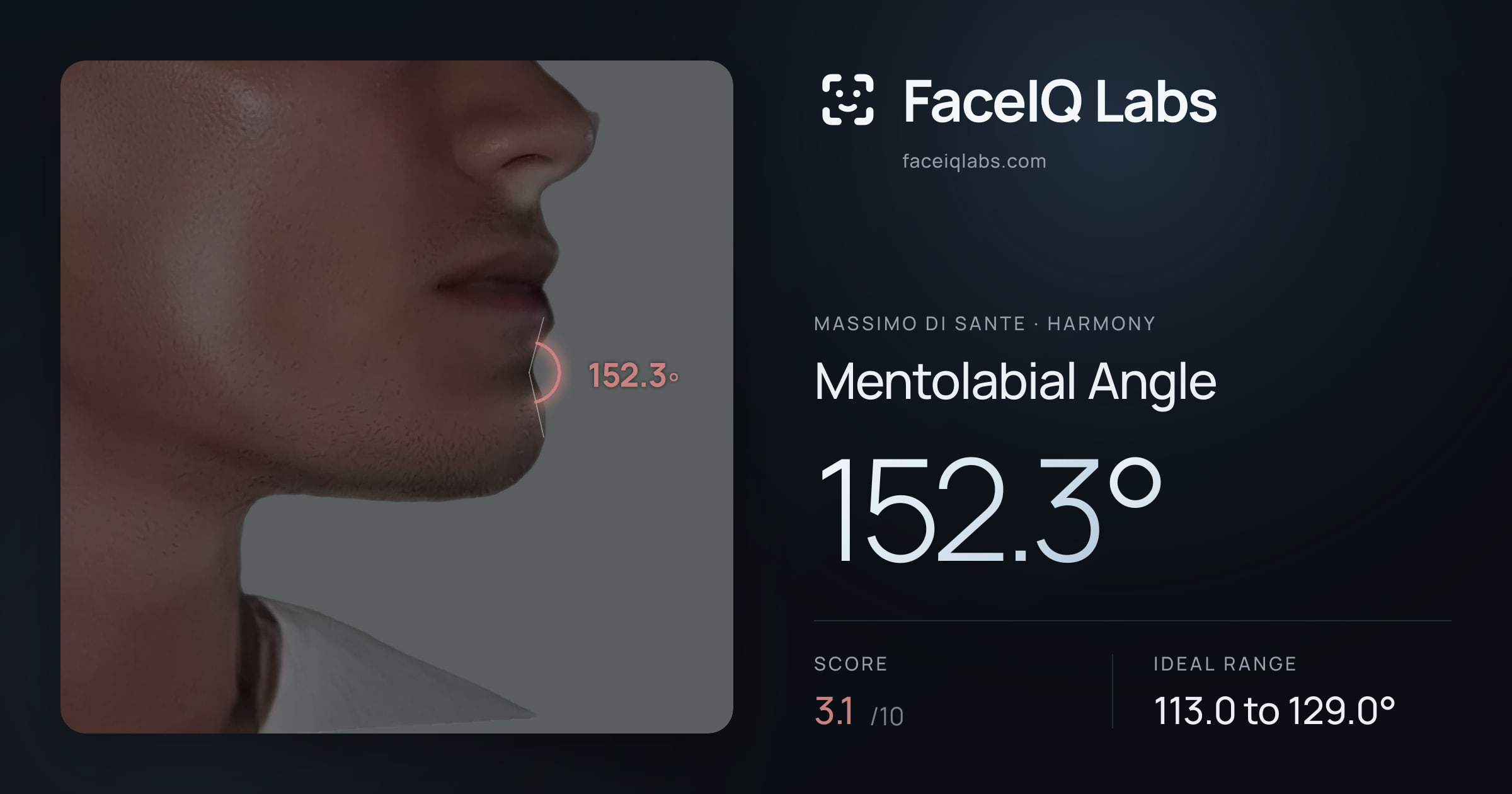 Massimo di Sante Mentolabial Angle: 152.3°, drawn on the photo