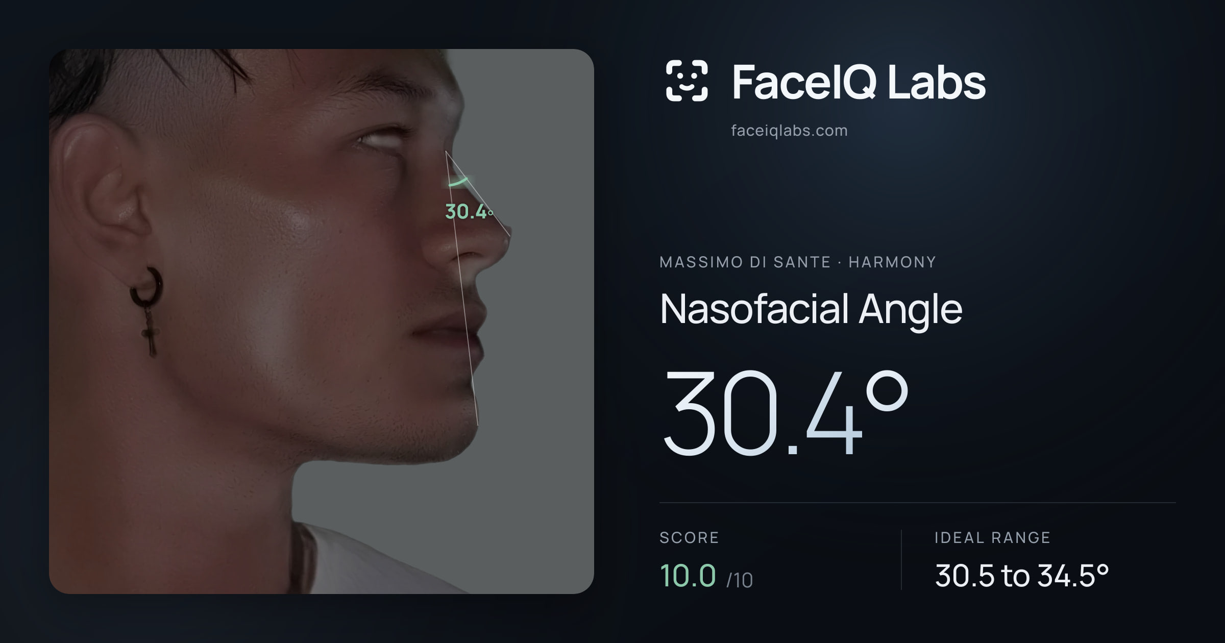 Massimo di Sante Nasofacial Angle: 30.4°, drawn on the photo