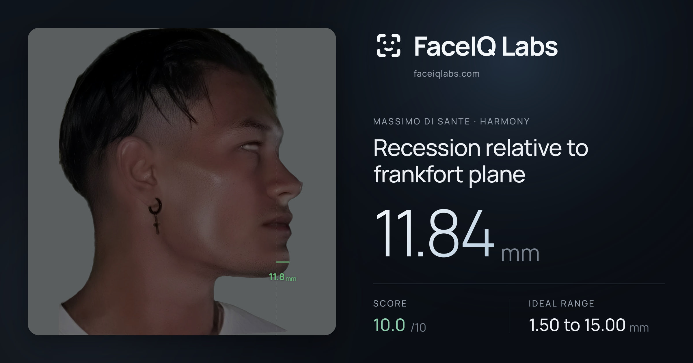 Massimo di Sante Recession relative to frankfort plane: 11.84mm, drawn on the photo