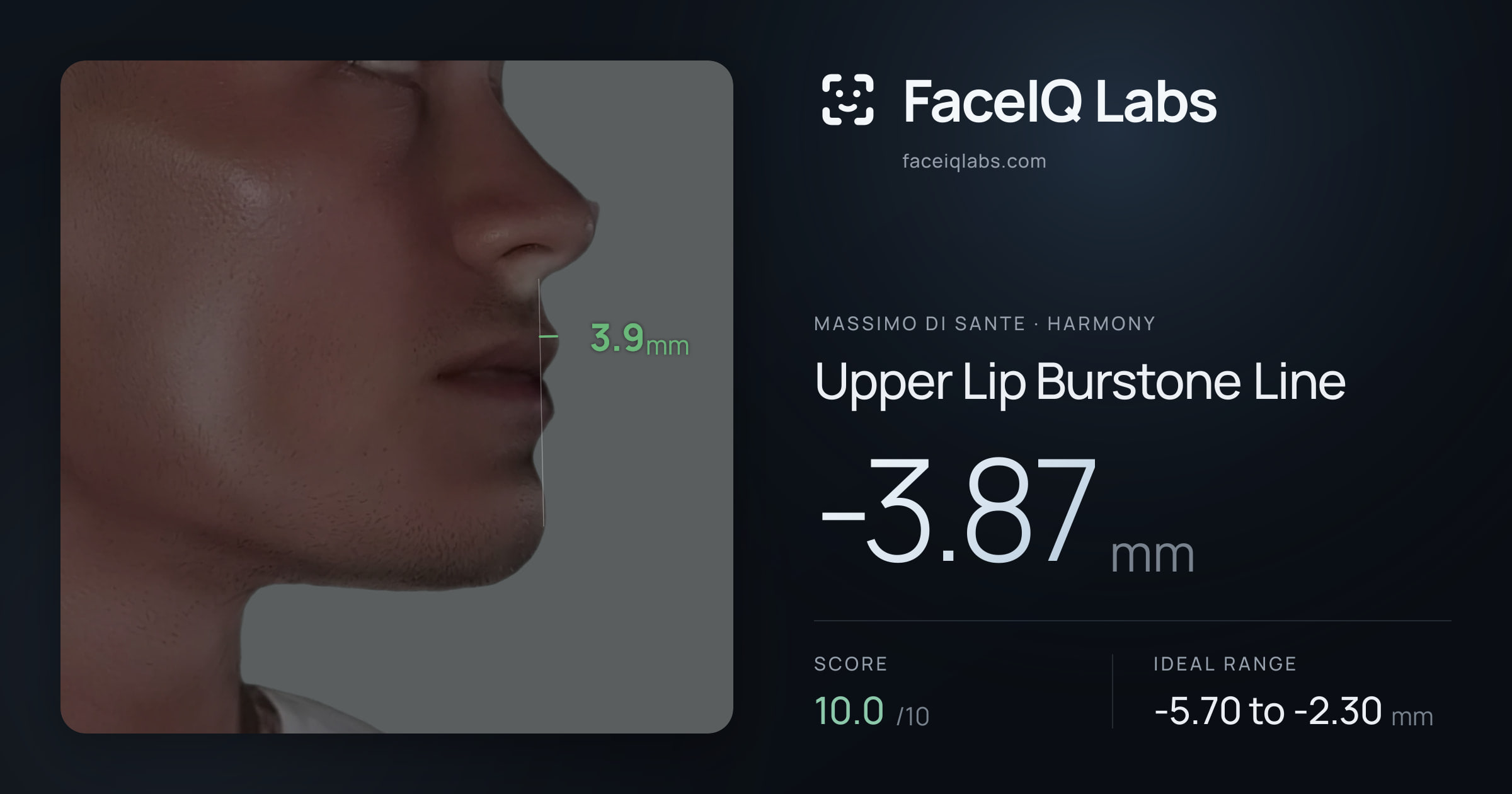 Massimo di Sante Upper Lip Burstone Line: -3.87mm, drawn on the photo