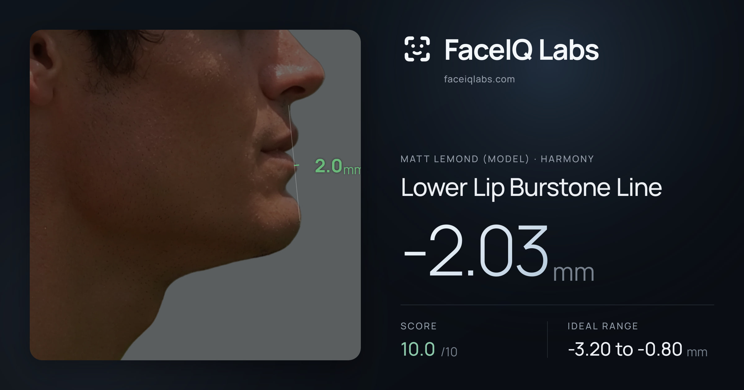 Matt Lemond (Model) Lower Lip Burstone Line: -2.03mm, drawn on the photo