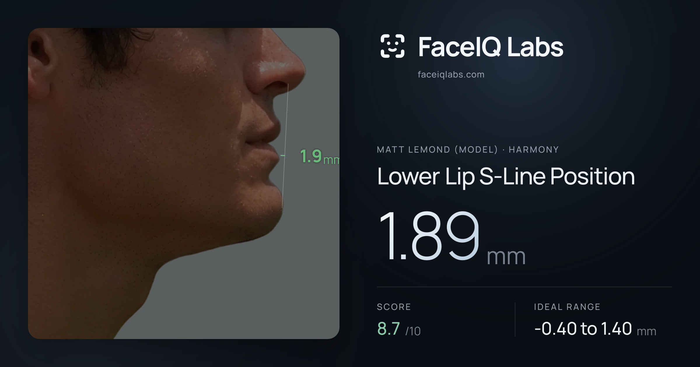 Matt Lemond (Model) Lower Lip S-Line Position: 1.89mm, drawn on the photo