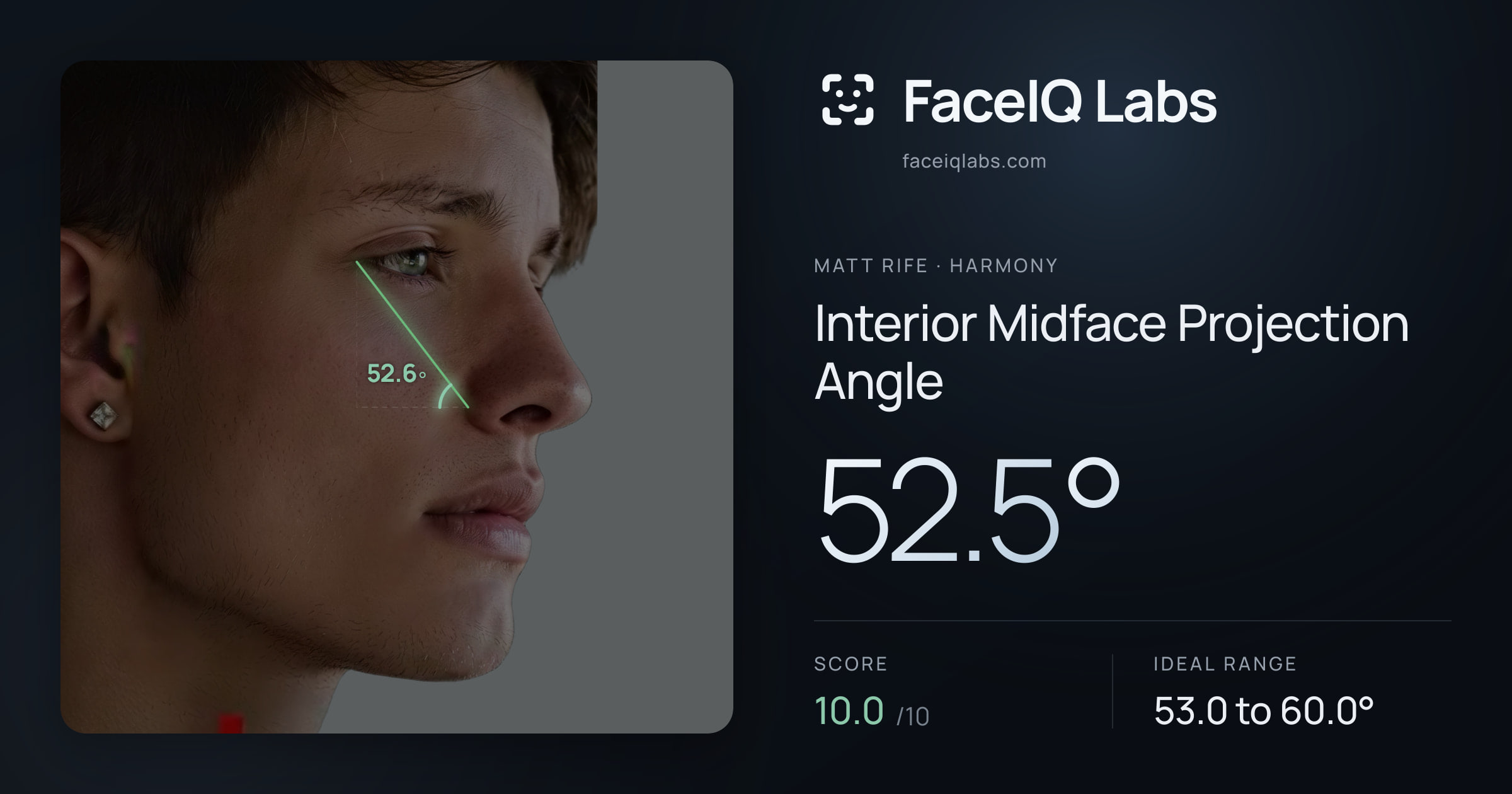 Matt Rife Interior Midface Projection Angle: 52.5°, drawn on the photo