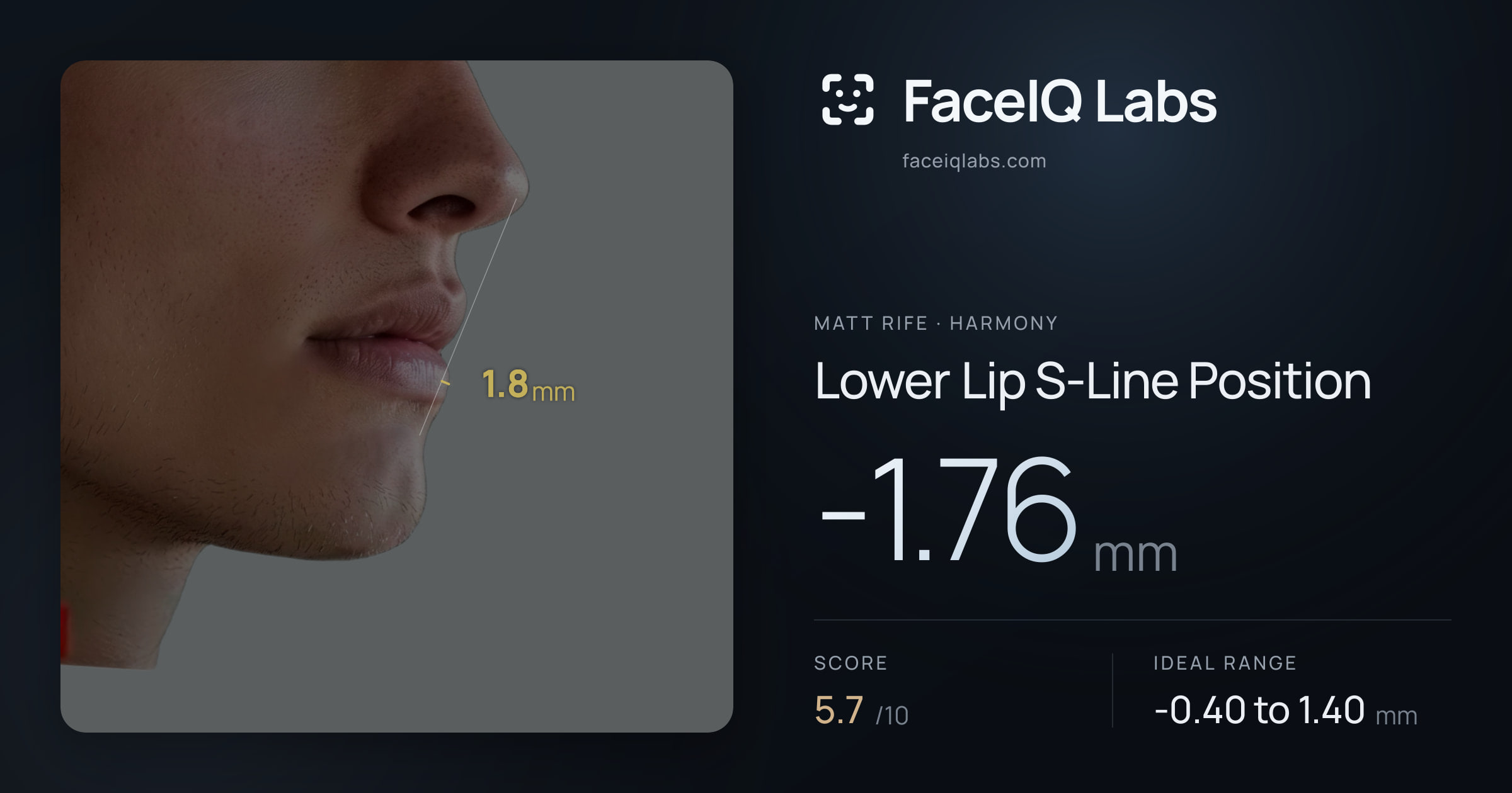 Matt Rife Lower Lip S-Line Position: -1.76mm, drawn on the photo