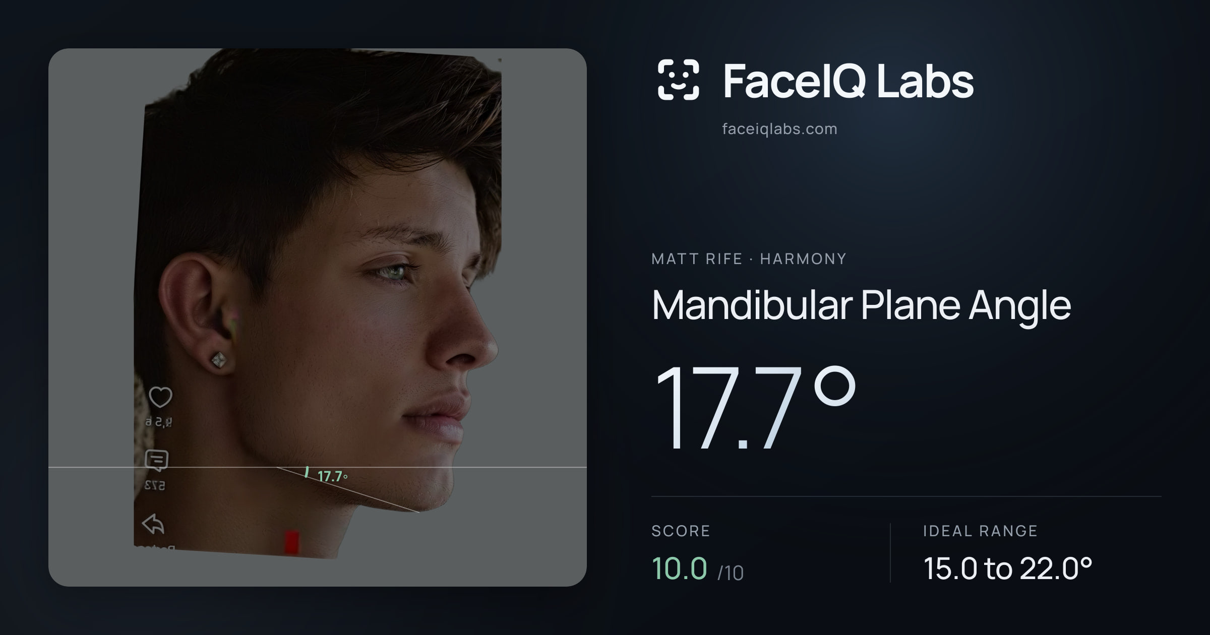 Matt Rife Mandibular Plane Angle: 17.7°, drawn on the photo