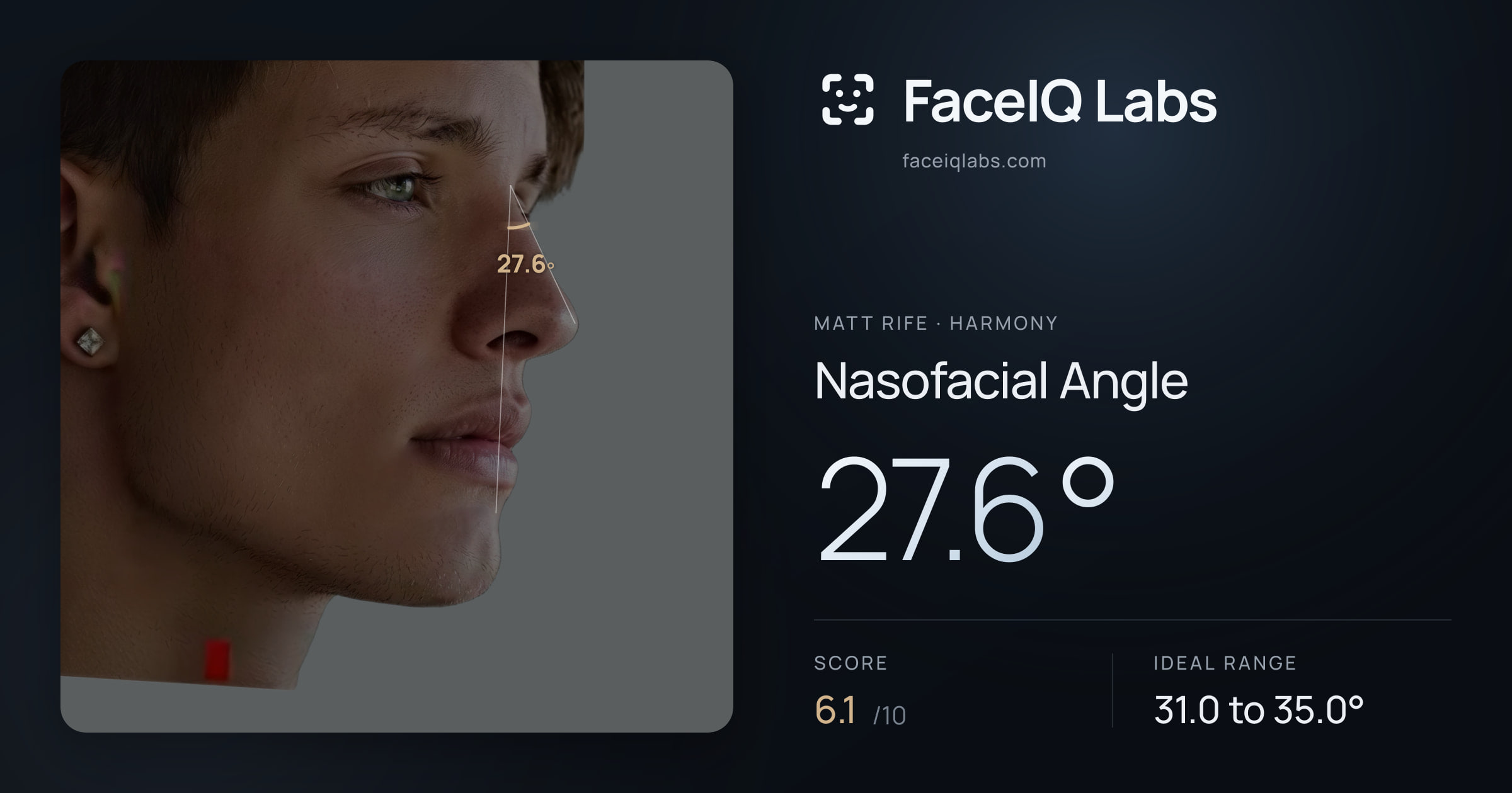 Matt Rife Nasofacial Angle: 27.6°, drawn on the photo