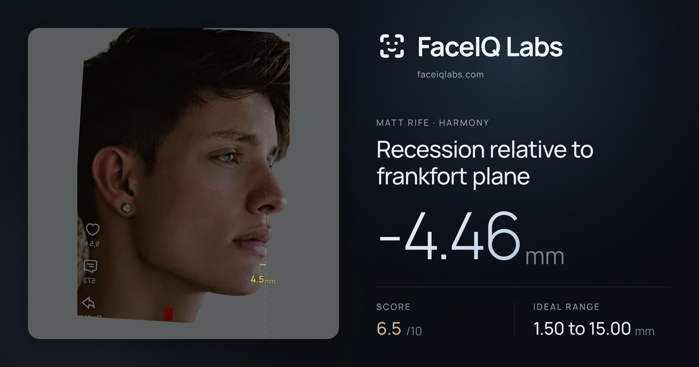 Matt Rife Recession relative to frankfort plane: -4.46mm, drawn on the photo