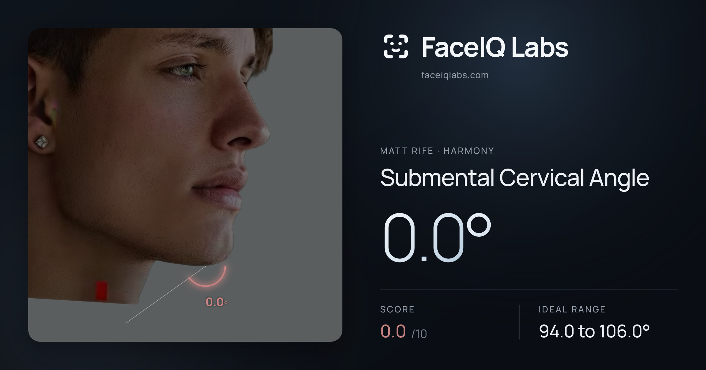 Matt Rife Submental Cervical Angle: 0.0°, drawn on the photo