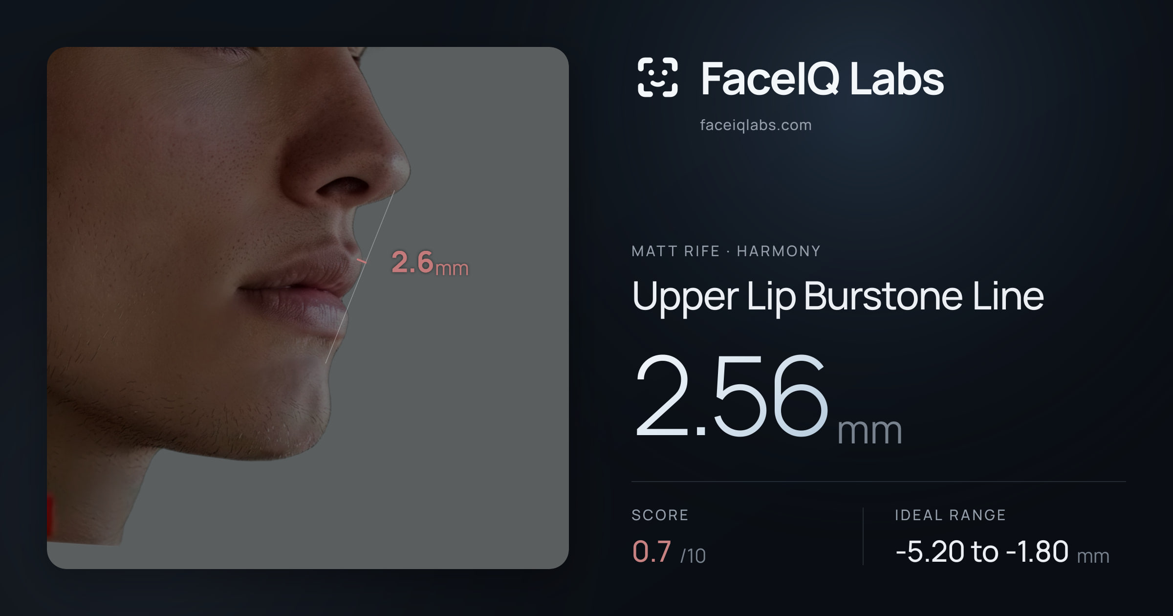 Matt Rife Upper Lip Burstone Line: 2.56mm, drawn on the photo