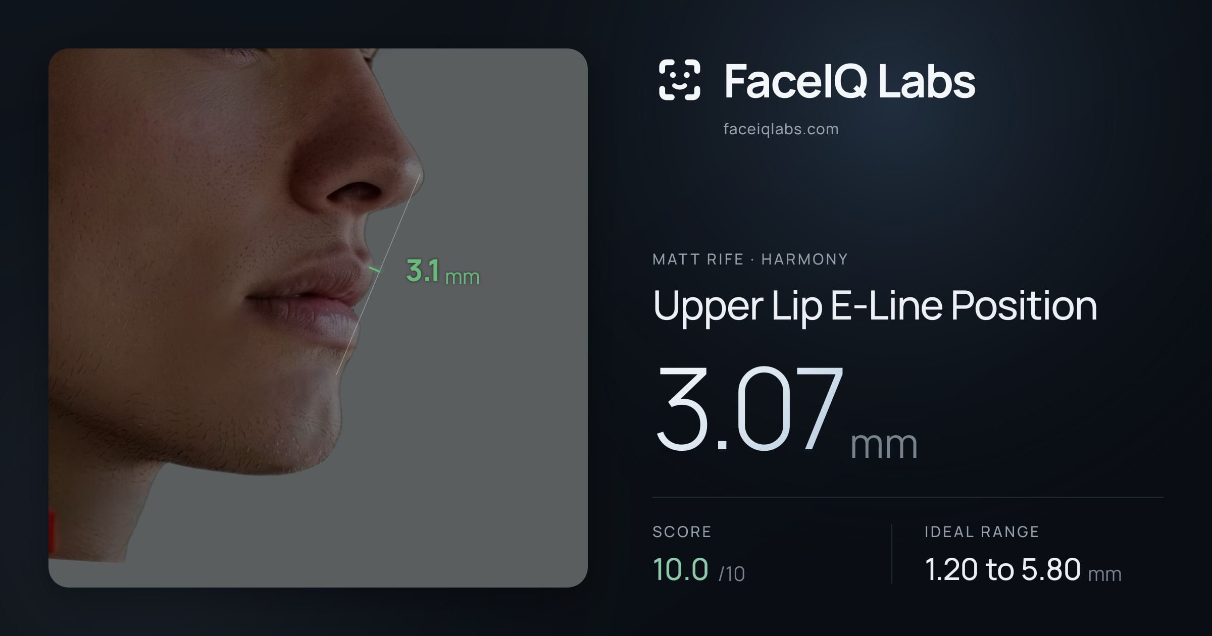 Matt Rife Upper Lip E-Line Position: 3.07mm, drawn on the photo