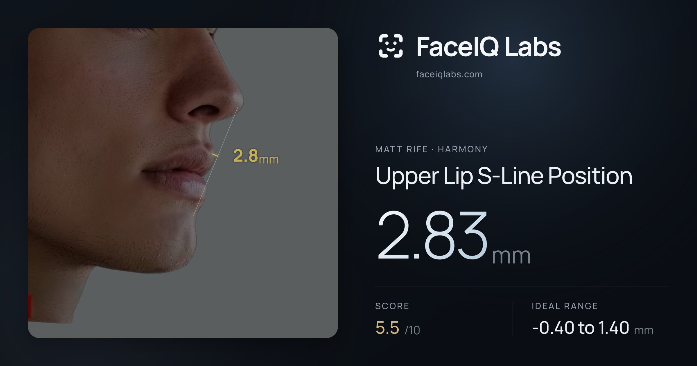 Matt Rife Upper Lip S-Line Position: 2.83mm, drawn on the photo